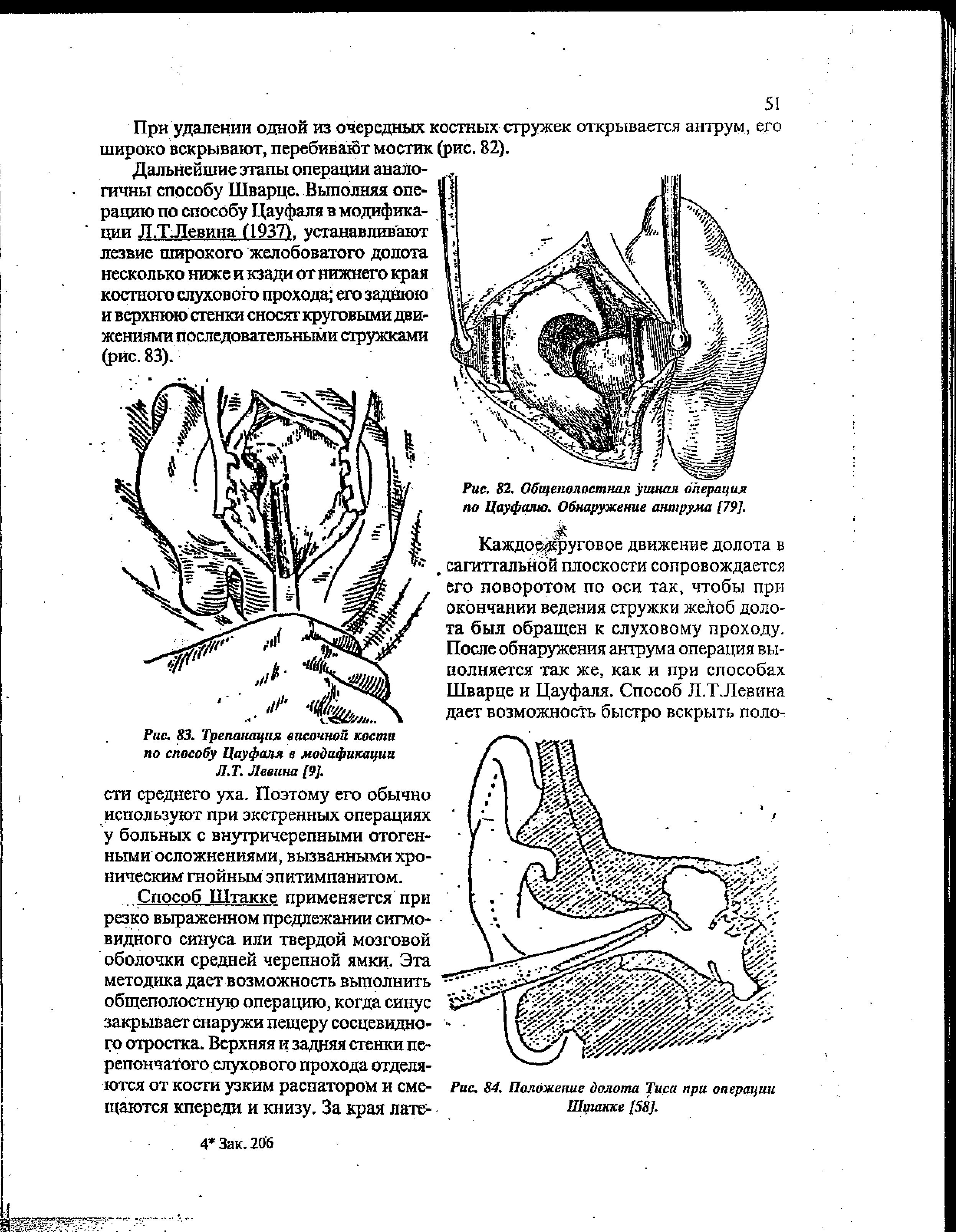 Рис. 82, Общеполостная ушная операция по Цауфалю. Обнаружение антрума [79].