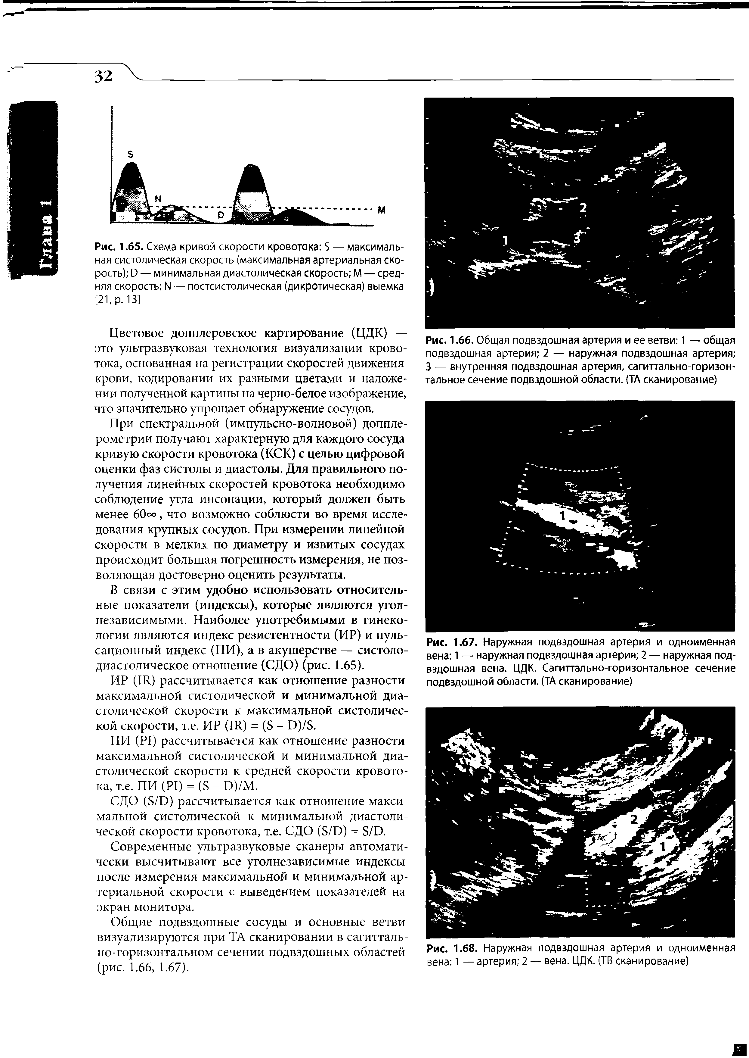 Рис. 1.67. Наружная подвздошная артерия и одноименная вена 1 — наружная подвздошная артерия 2 — наружная подвздошная вена. ЦДК. Сагиттально-горизонтальное сечение подвздошной области. (ТА сканирование)...