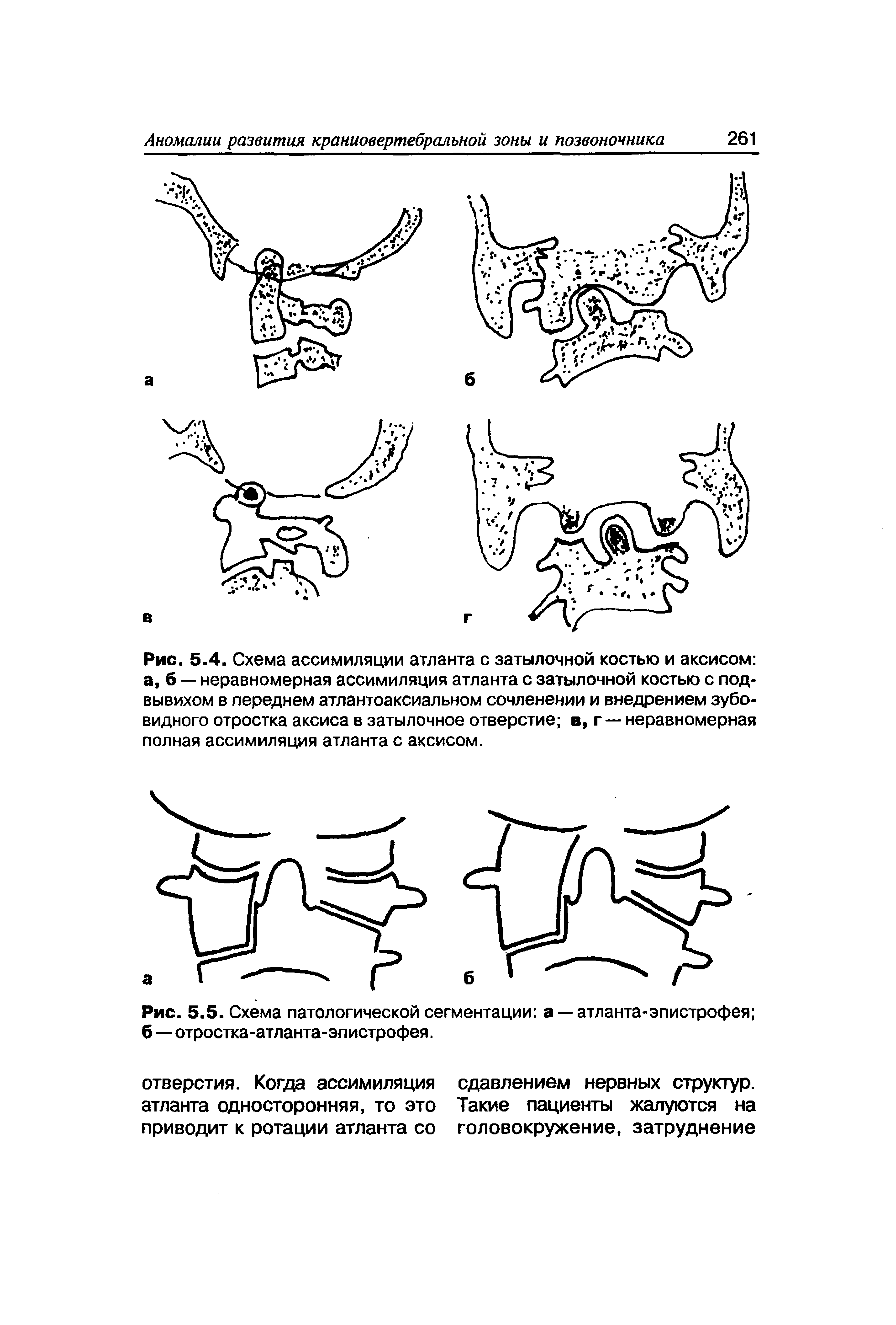 Рис. 5.4. Схема ассимиляции атланта с затылочной костью и аксисом а, б — неравномерная ассимиляция атланта с затылочной костью с подвывихом в переднем атлантоаксиальном сочленении и внедрением зубовидного отростка аксиса в затылочное отверстие в, г — неравномерная полная ассимиляция атланта с аксисом.