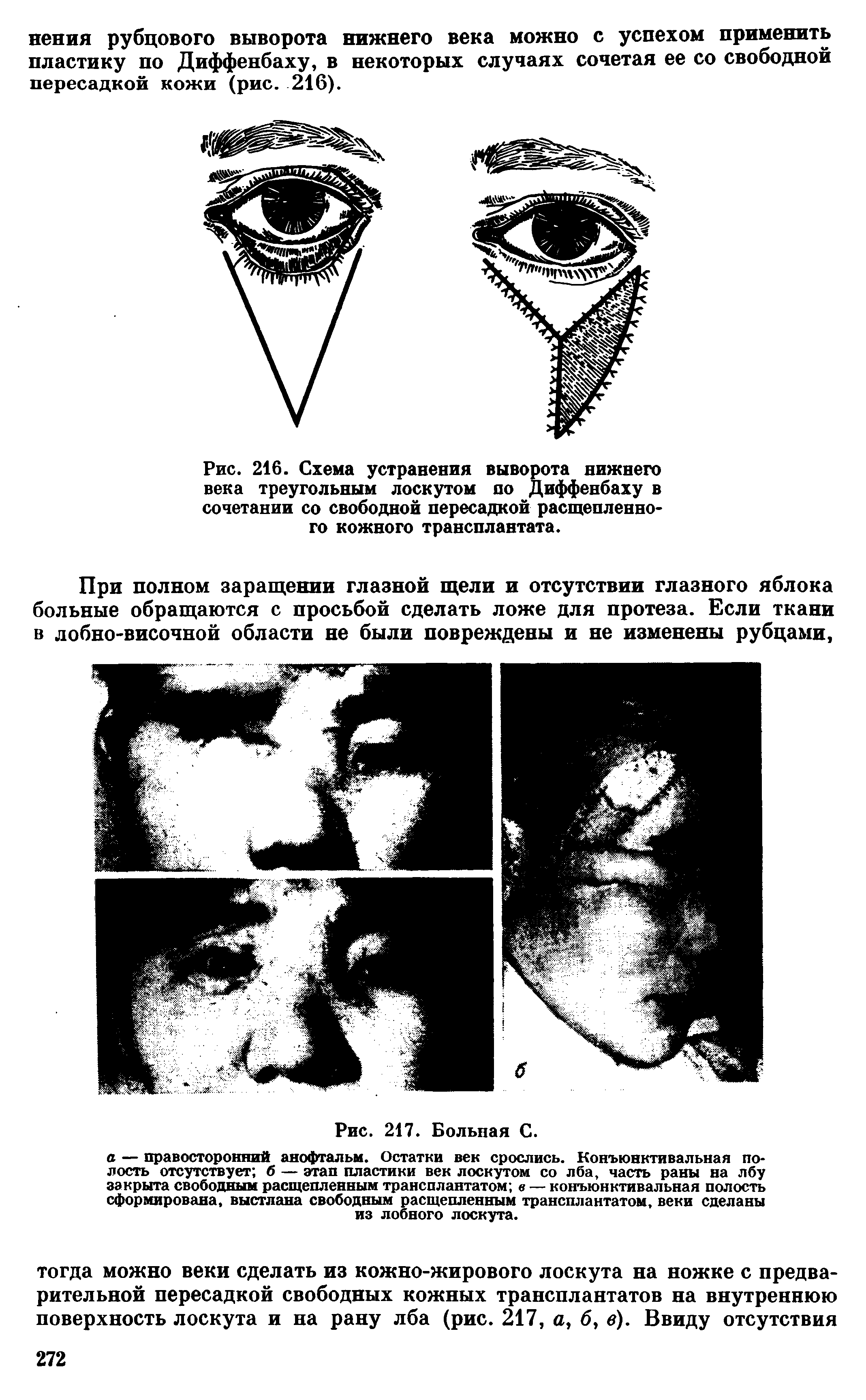 Рис. 216. Схема устранения выворота нижнего века треугольным лоскутом до Диффенбаху в сочетании со свободной пересадкой расщепленного кожного трансплантата.