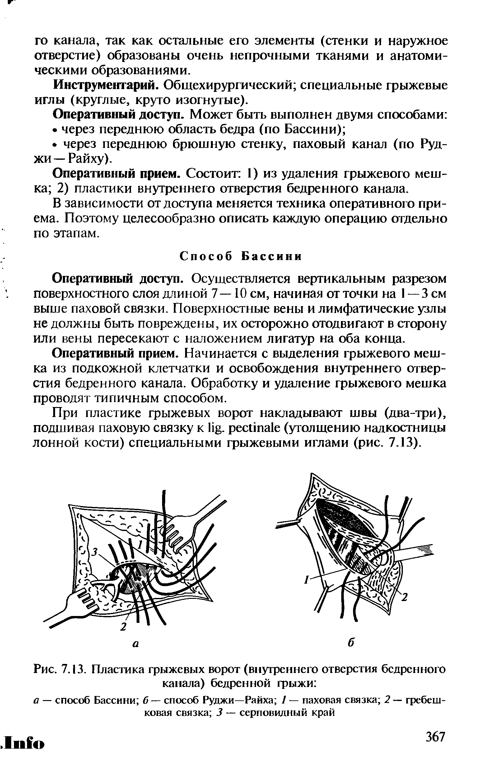 Рис. 7.13. Пластика грыжевых ворот (внутреннего отверстия бедренного канала) бедренной грыжи ...