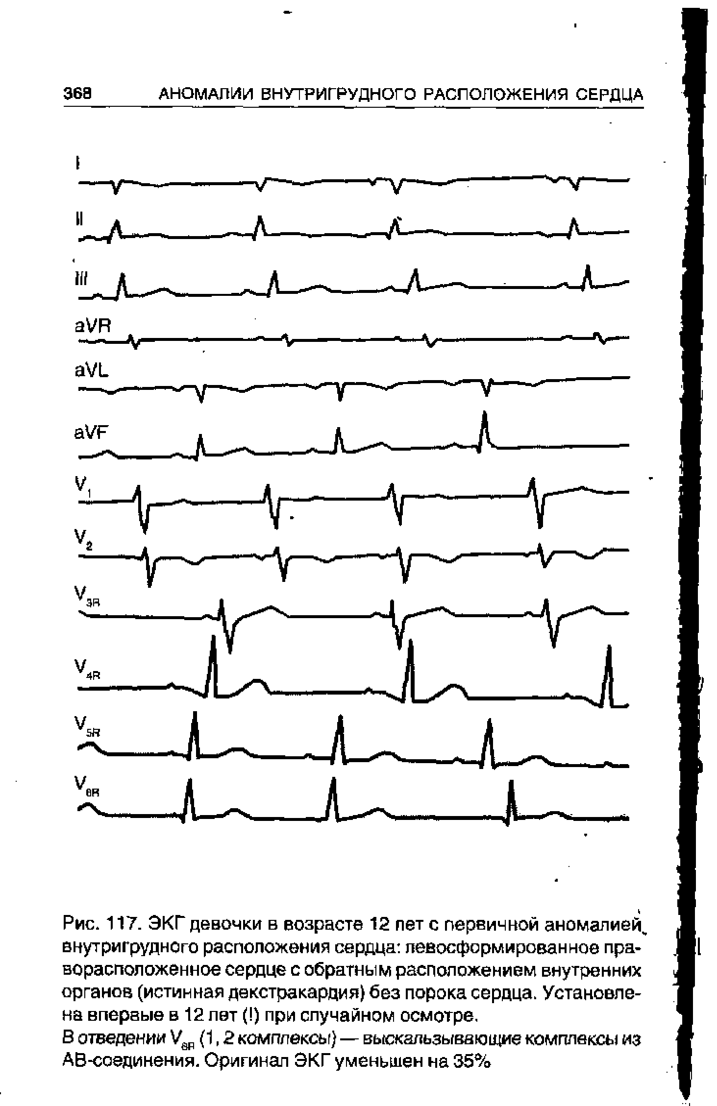 Рис. 117. ЭКГ девочки в возрасте 12 пет с первичной аномалией, внутригрудного расположения сердца певосформированное праворасположенное сердце с обратным расположением внутренних органов (истинная декстракардия) без порока сердца. Установлена впервые в 12 пет ( ) при случайном осмотре.