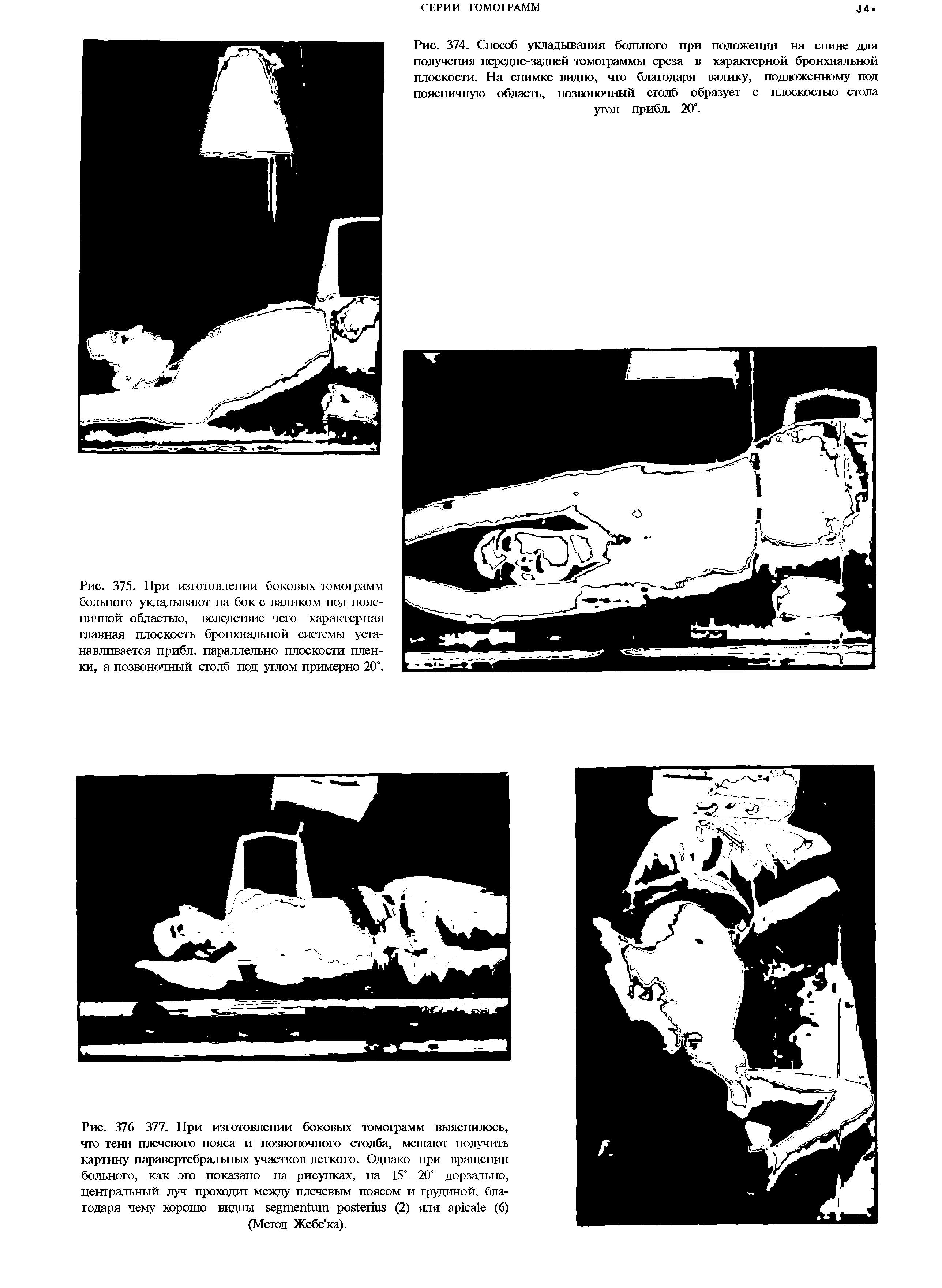 Рис. 375. При изготовлении боковых томограмм больного укладывают на бок с валиком под поясничной областью, вследствие чего характерная главная плоскость бронхиальной системы устанавливается прибл. параллельно плоскости пленки, а позвоночный столб под углом примерно 20°.