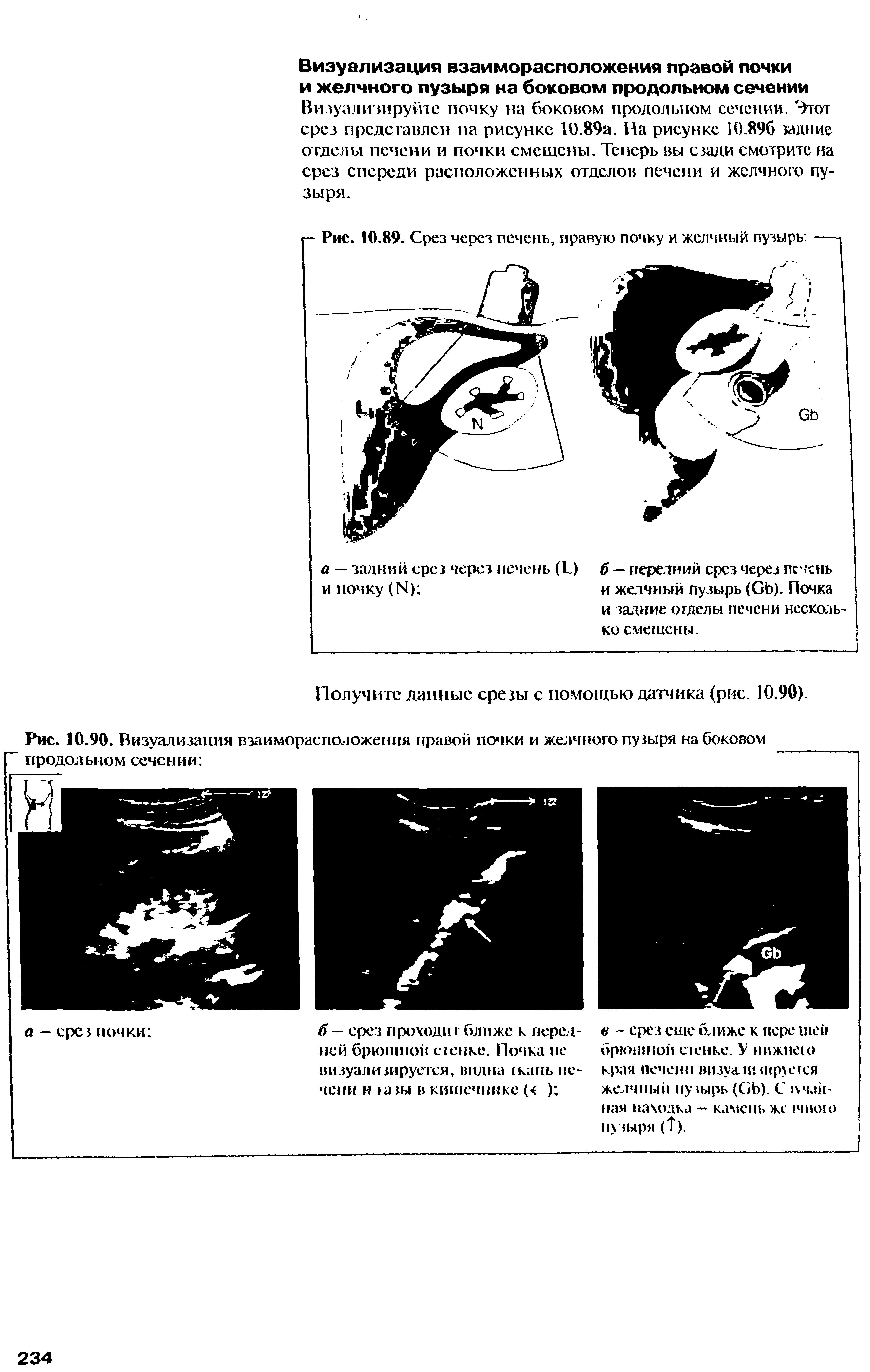 Рис. 10.89. Срез через печень, правую почку и желчный пузырь ...
