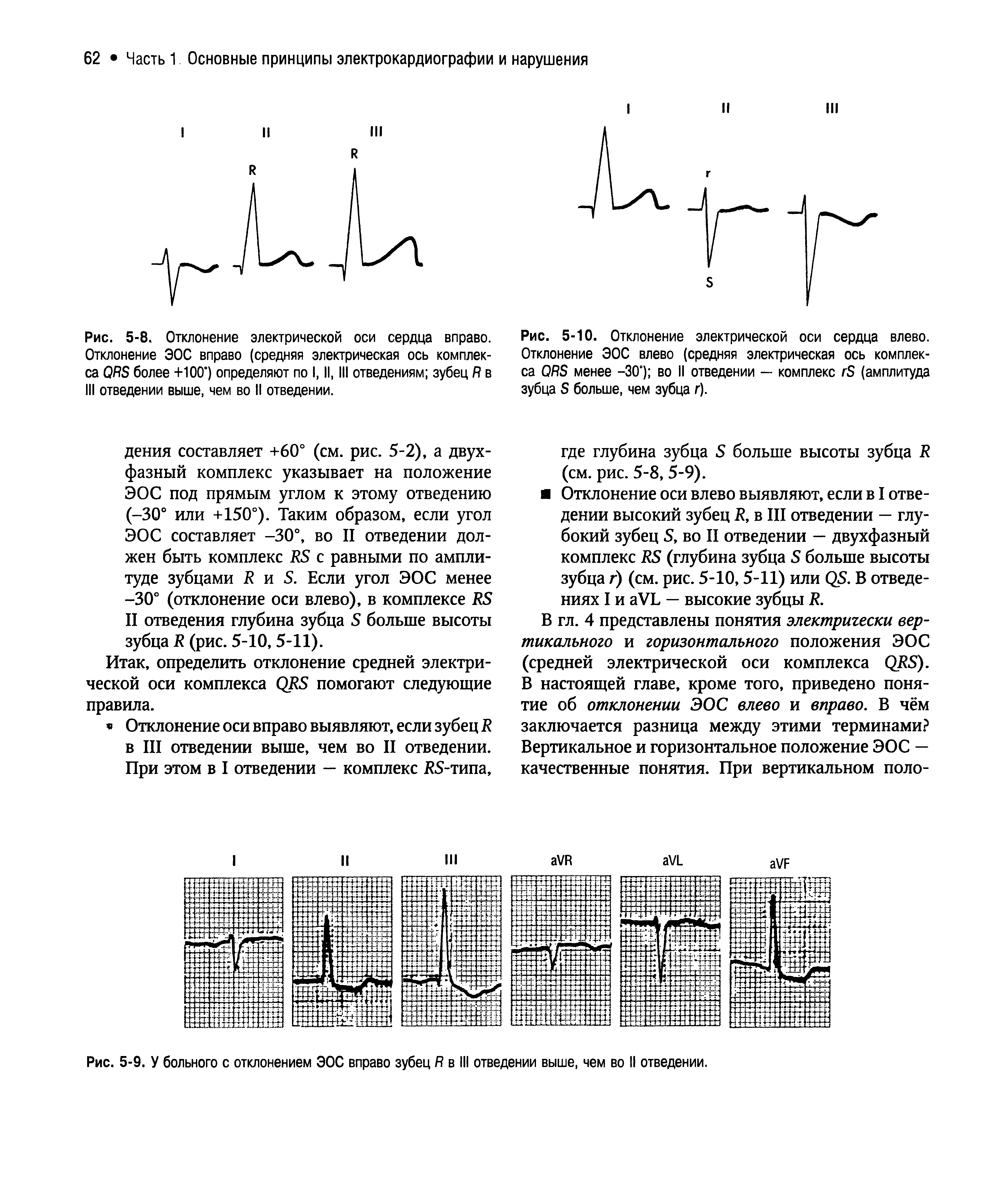 Рис. 5-8. Отклонение электрической оси сердца вправо. Отклонение ЭОС вправо (средняя электрическая ось комплекса QRS более +100°) определяют по I, II, III отведениям зубец R в III отведении выше, чем во II отведении.