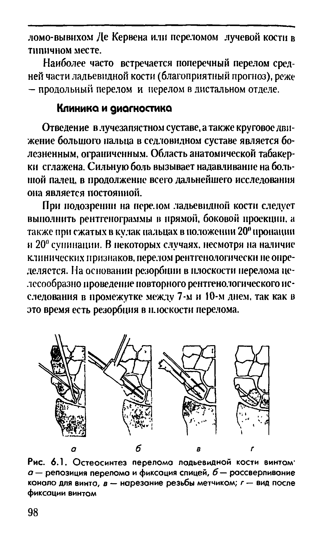 Рис. 6.1. Остеосинтез переломе лодьевидной кости винтом а — репозиция переломе и фиксоция спицей, б— россверливоние коноло для винте, в — нарезоние резьбы метчиком г — вид после фиксоции винтом...