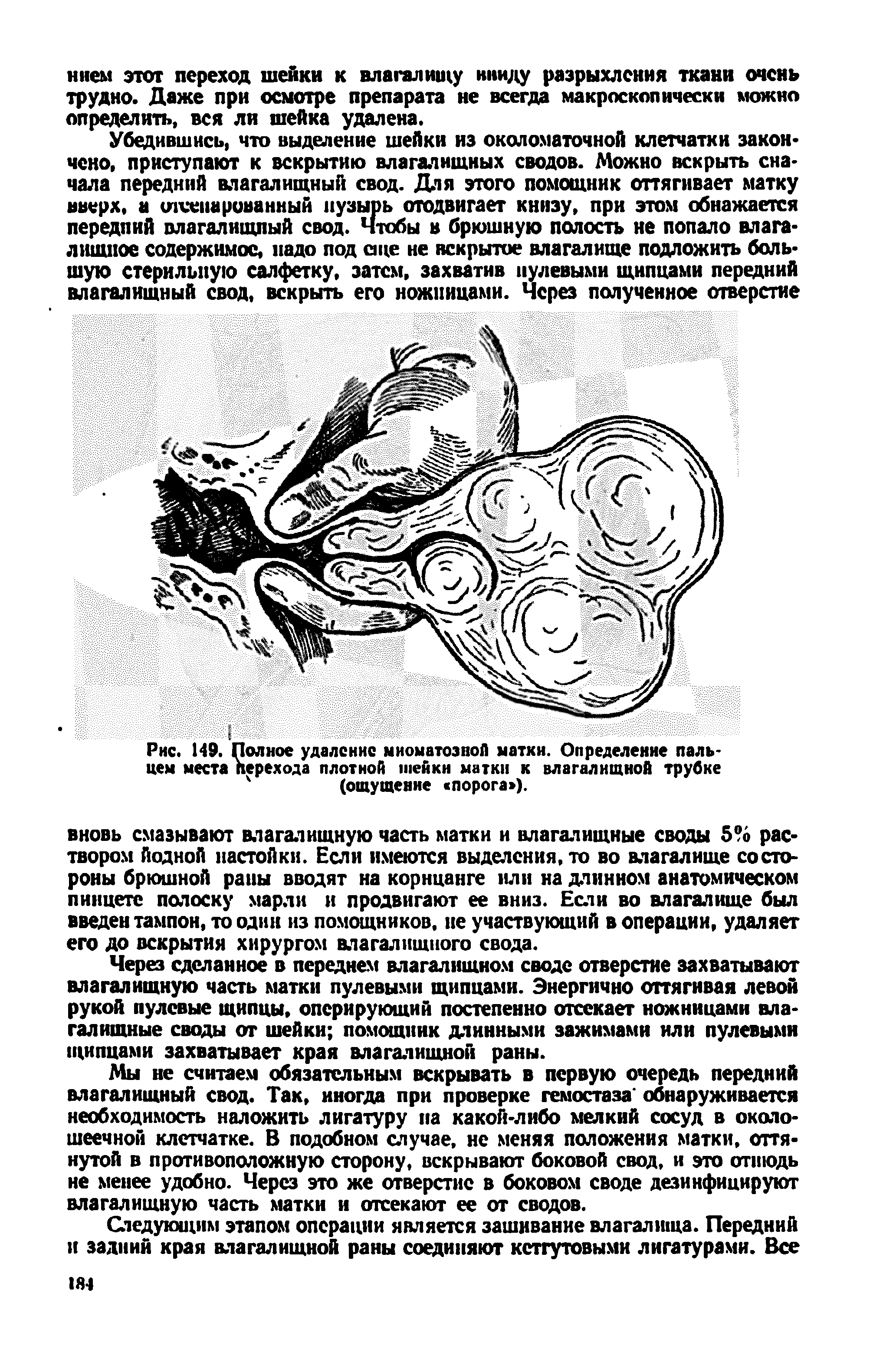 Рис. 149. Полное удаление миоматозноЛ матки. Определение пальцем места перехода плотной шейки матки к влагалищной трубке 4 (ощущение порога ).