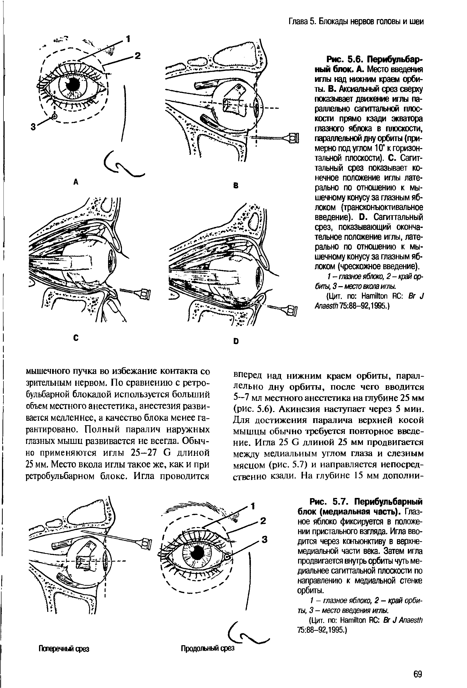 Рис. 5.6. Перибульбар-ный блок. А. Место введения иглы над нижним краем орбиты. В. Аксиальный срез сверху показывает движение иглы параллельно сагиттальной плоскости прямо кзади экватора глазного яблока в плоскости,...