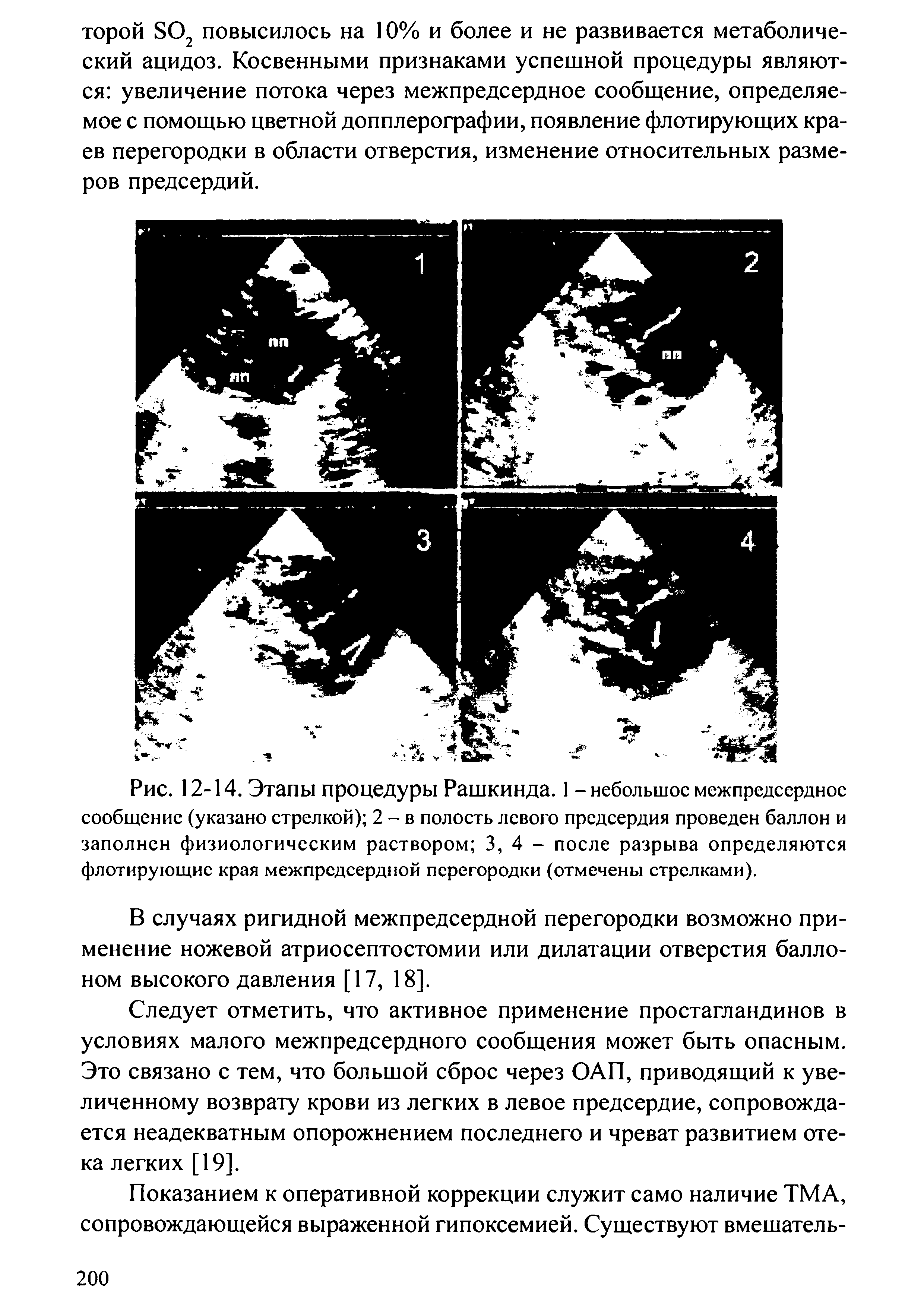 Рис. 12-14. Этапы процедуры Рашкинда. 1 - небольшое межпредсердное сообщение (указано стрелкой) 2 - в полость левого предсердия проведен баллон и заполнен физиологическим раствором 3, 4 - после разрыва определяются флотирующие края межпредсердной перегородки (отмечены стрелками).