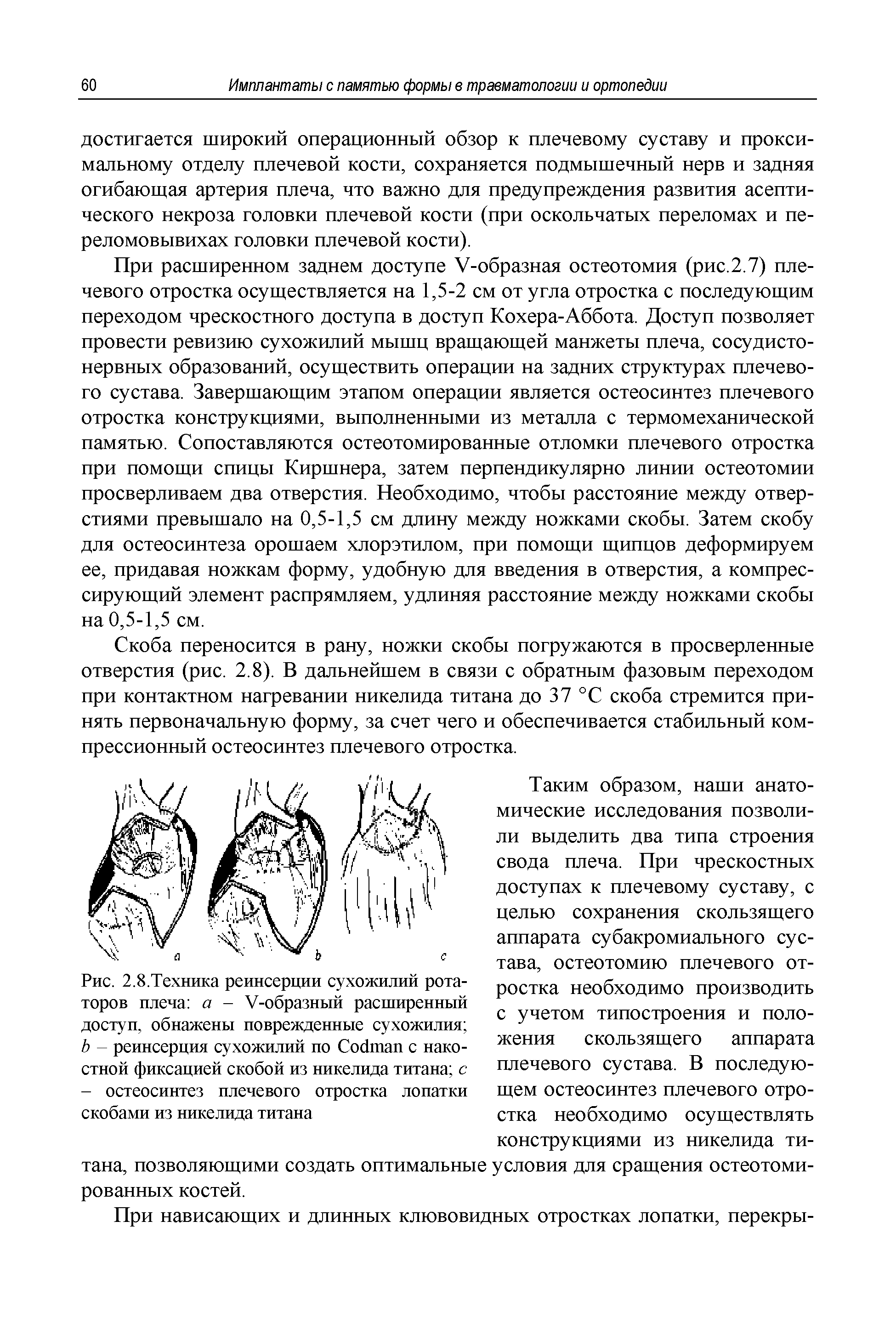 Рис. 2.8.Техника реинсерции сухожилий ротаторов плеча а - У-образный расширенный доступ, обнажены поврежденные сухожилия Ь - реинсерция сухожилий по Сосйпап с накостной фиксацией скобой из никелида титана с - остеосинтез плечевого отростка лопатки скобами из никелида титана...