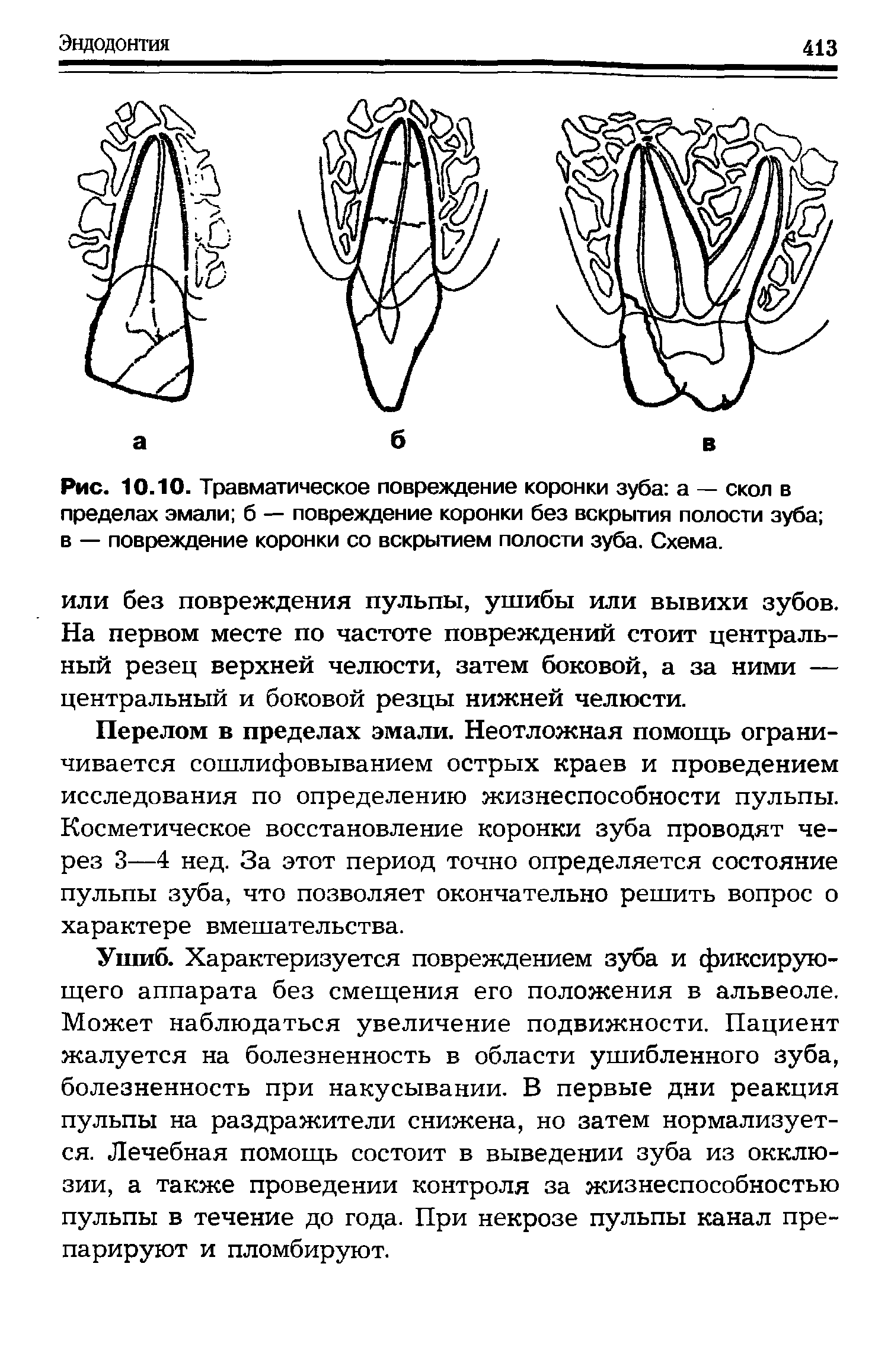 Рис. 10.10. Травматическое повреждение коронки зуба а — скол в пределах эмали б — повреждение коронки без вскрытия полости зуба в — повреждение коронки со вскрытием полости зуба. Схема.