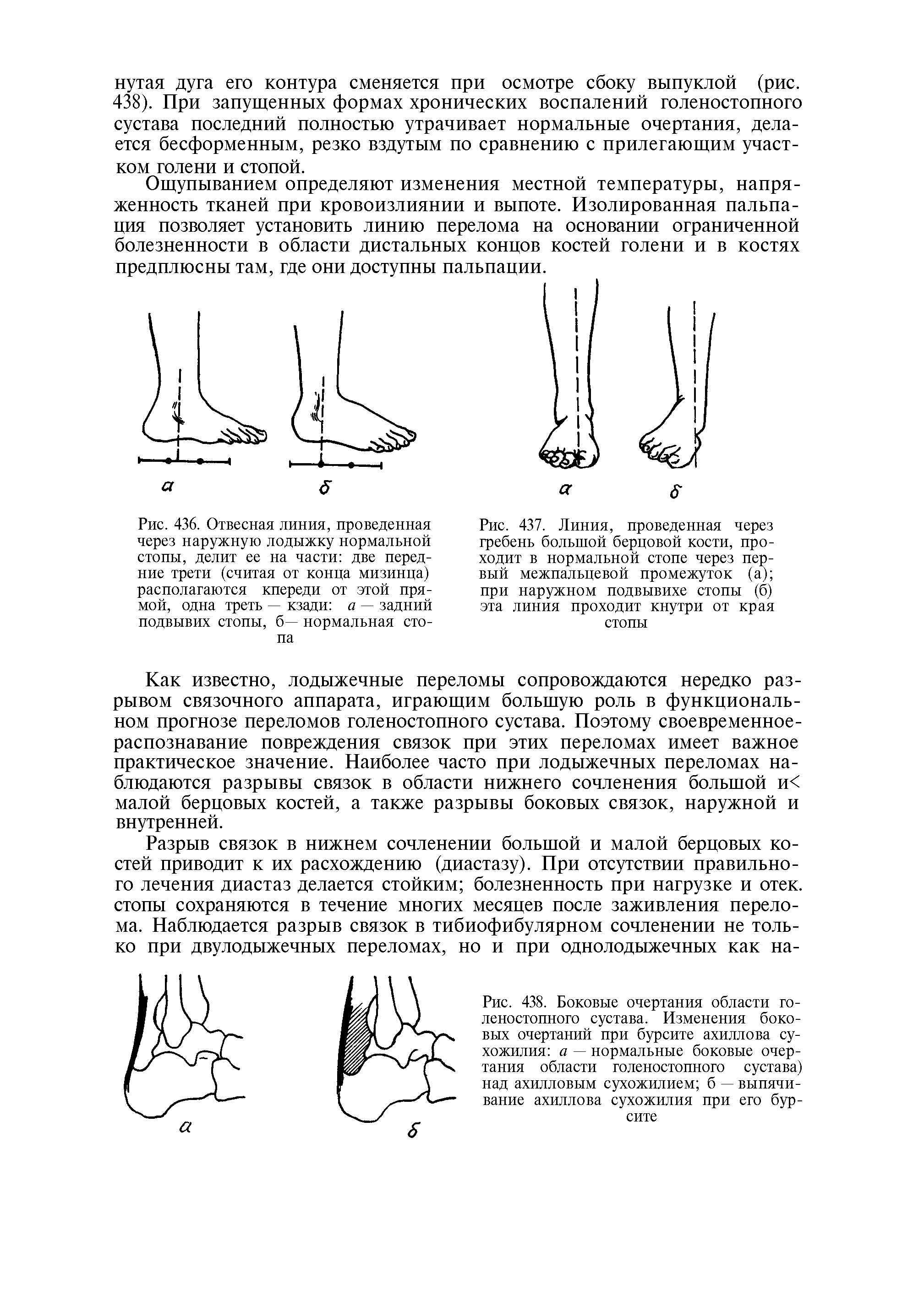 Рис. 438. Боковые очертания области голеностопного сустава. Изменения боковых очертаний при бурсите ахиллова сухожилия а — нормальные боковые очертания области голеностопного сустава) над ахилловым сухожилием б — выпячивание ахиллова сухожилия при его бурсите...