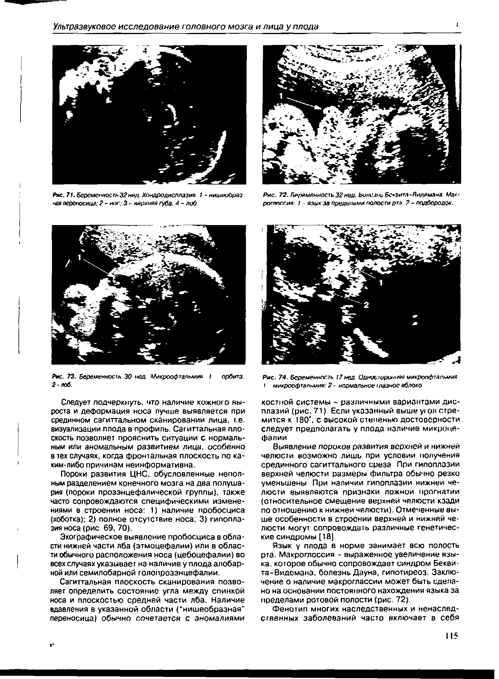 Рис. 74. Беременность 7мед. Одмосюрш няя микроофтапнмяя микроофтальмия 2 - нормальное мазное яблоко...