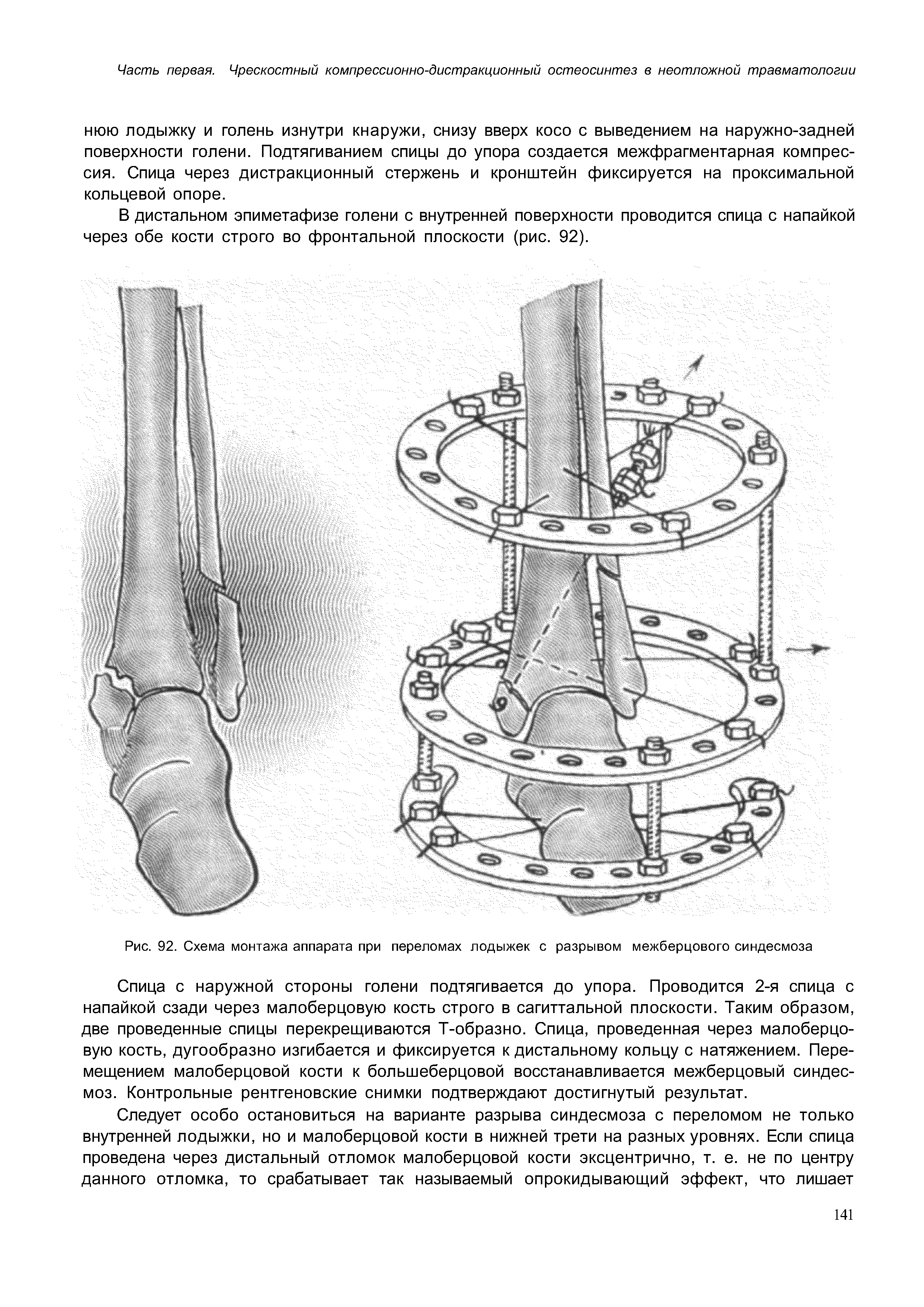 Рис. 92. Схема монтажа аппарата при переломах лодыжек с разрывом межберцового синдесмоза...