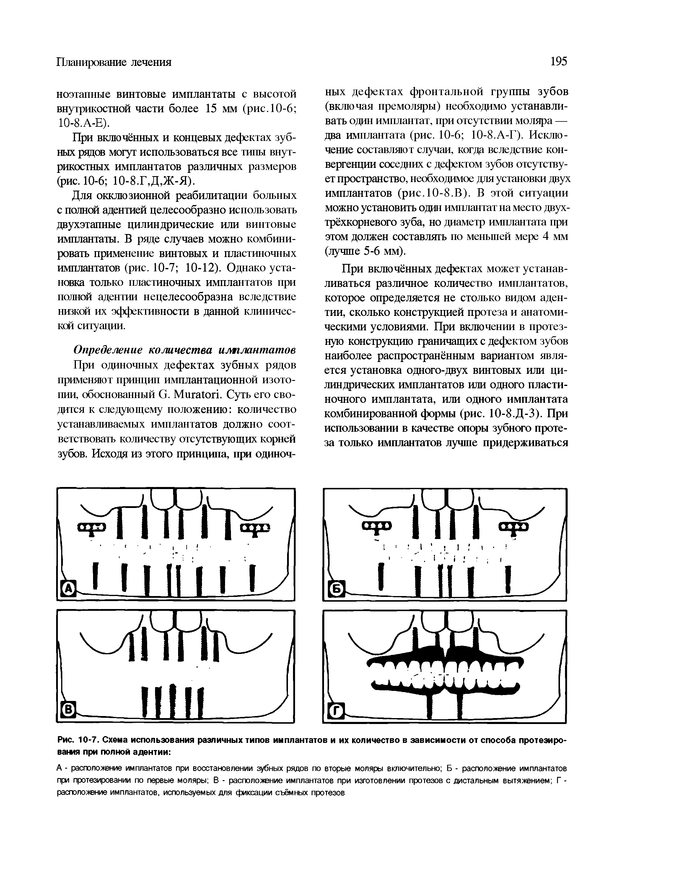 Рис. 10 7. Схема использования различных типов имплантатов и их количество в зависимости от способа протезиро вания при полной адентии ...