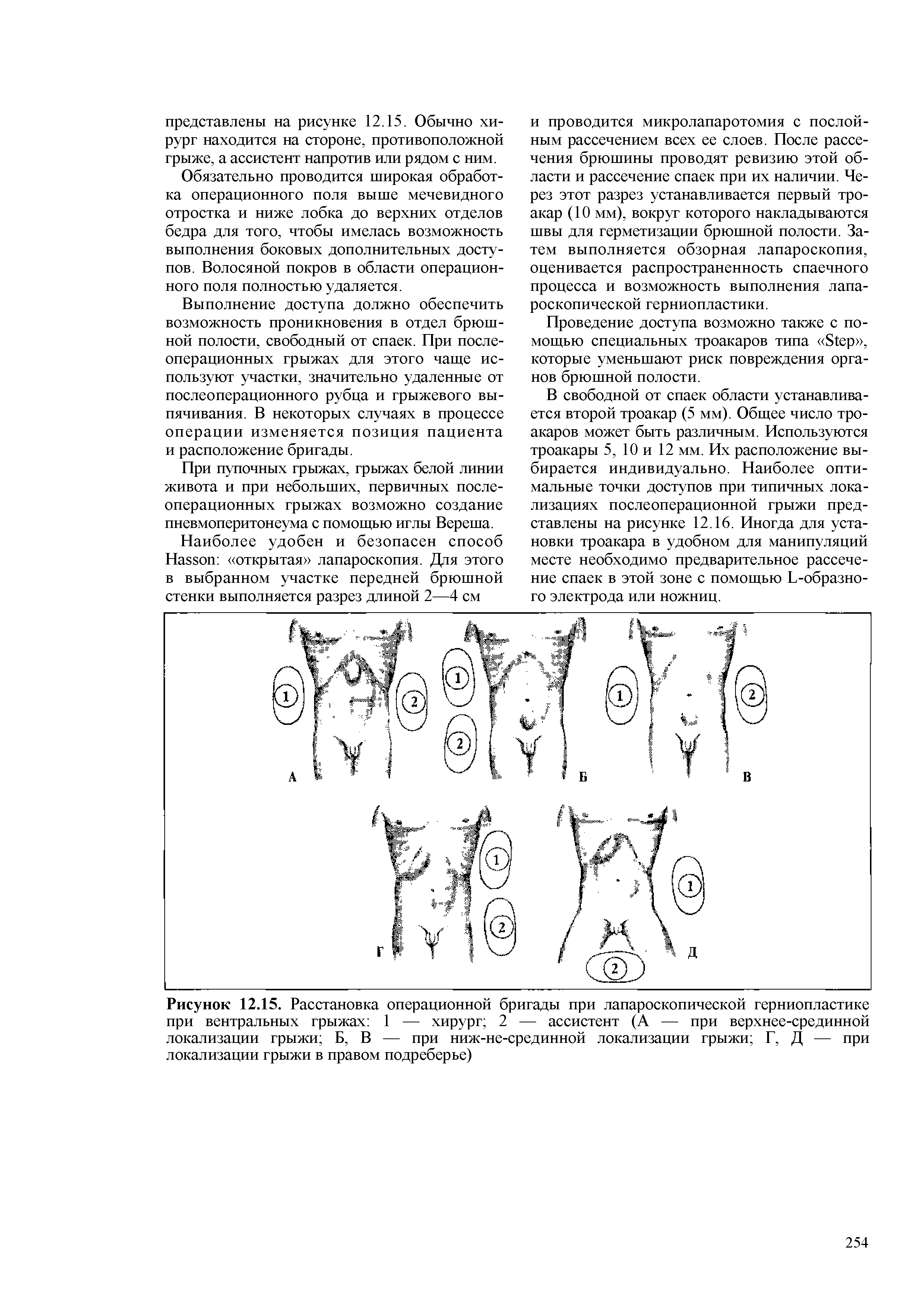 Рисунок 12.15. Расстановка операционной бригады при лапароскопической герниопластике при вентральных грыжах 1 — хирург 2 — ассистент (А — при верхнее-срединной локализации грыжи Б, В — при ниж-не-срединной локализации грыжи Г, Д — при локализации грыжи в правом подреберье)...