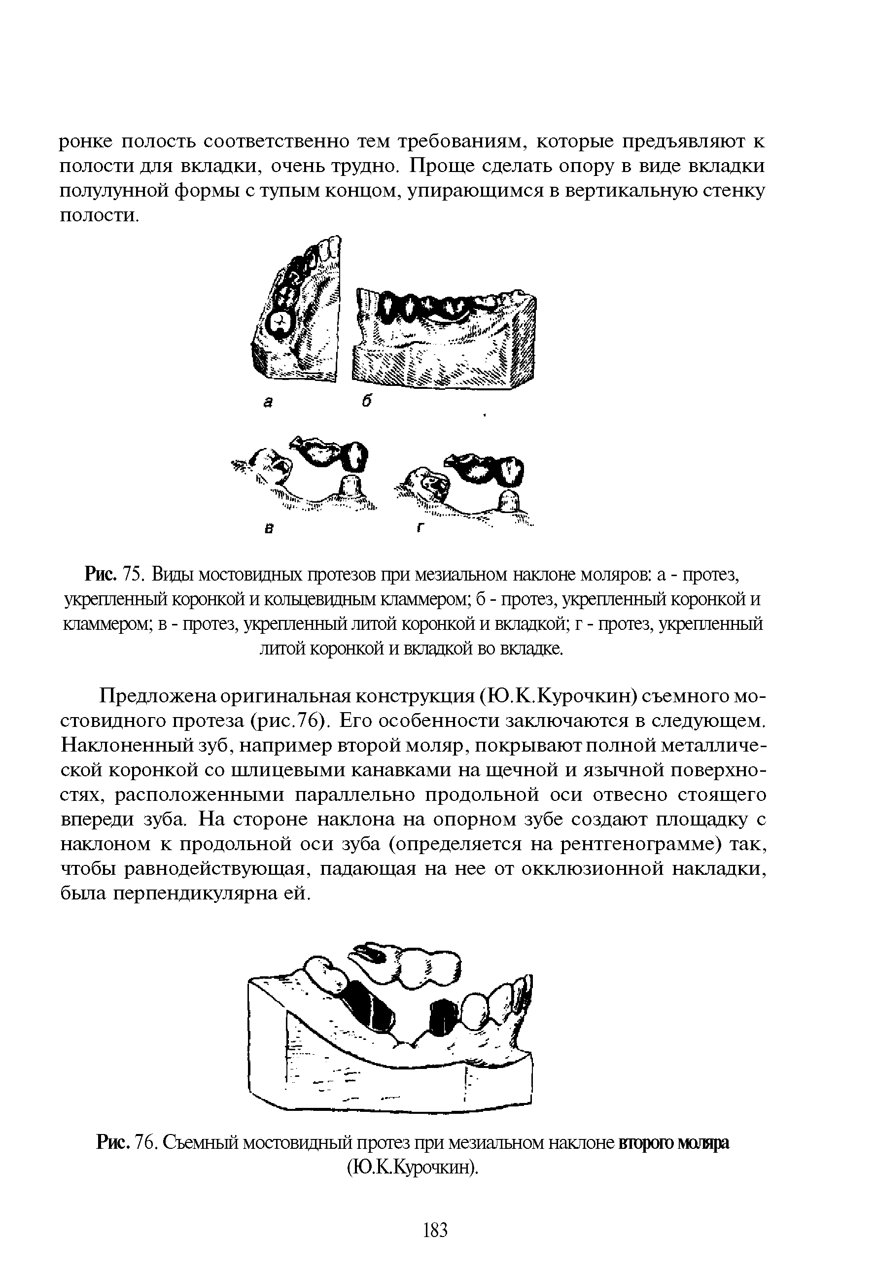 Рис. 75. Ввды мостоввдных протезов при мезиальном наклоне моляров а - протез, укрепленный коронкой и кольцеввдным кламмером б - протез, укрепленный коронкой и кламмером в - протез, укрепленный литой коронкой и вкладкой г - протез, укрепленный лигой коронкой и вкладкой во вкладке.