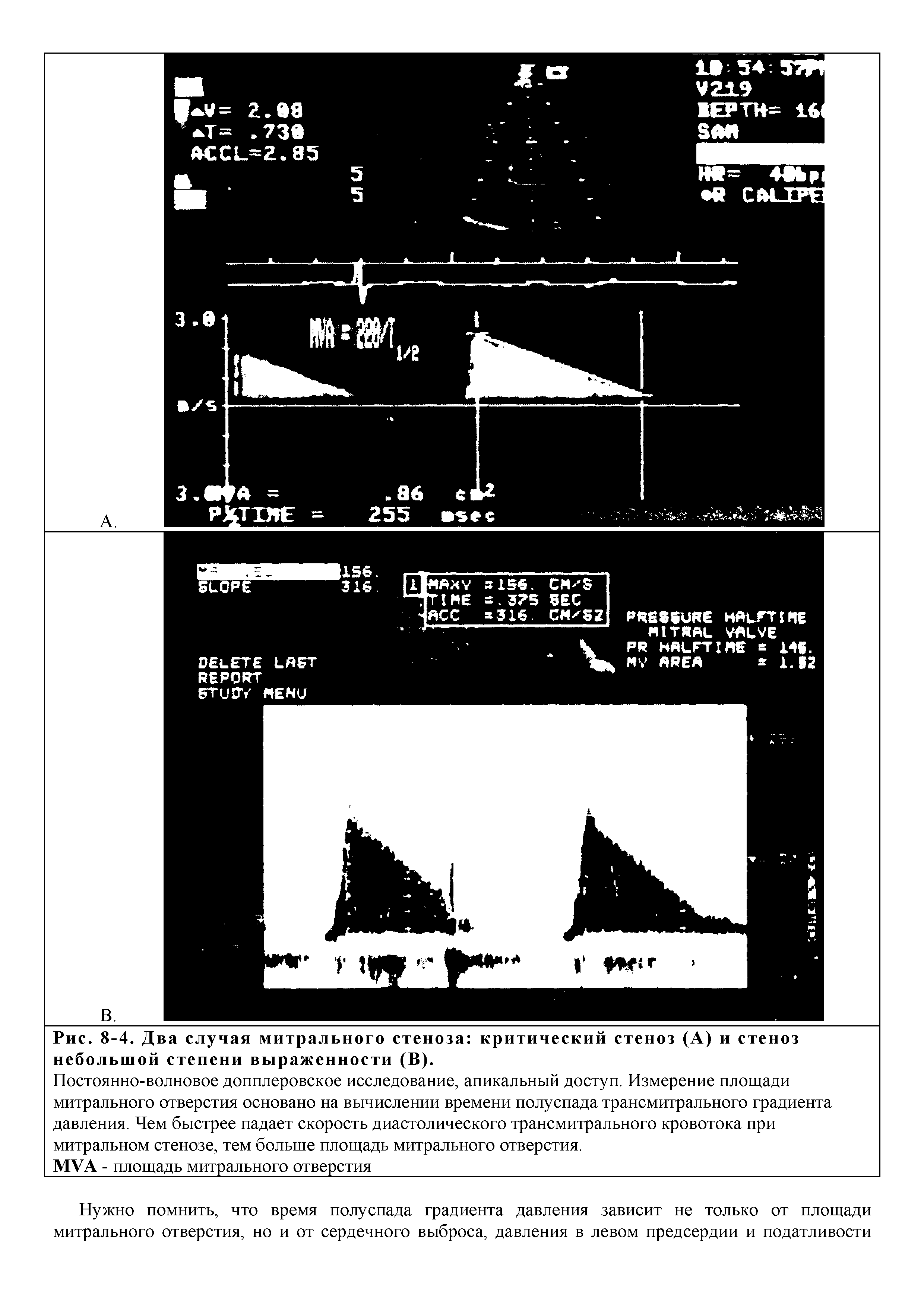 Рис. 8-4. Два случая митрального стеноза критический стеноз (А) и стеноз небольшой степени выраженности (В).