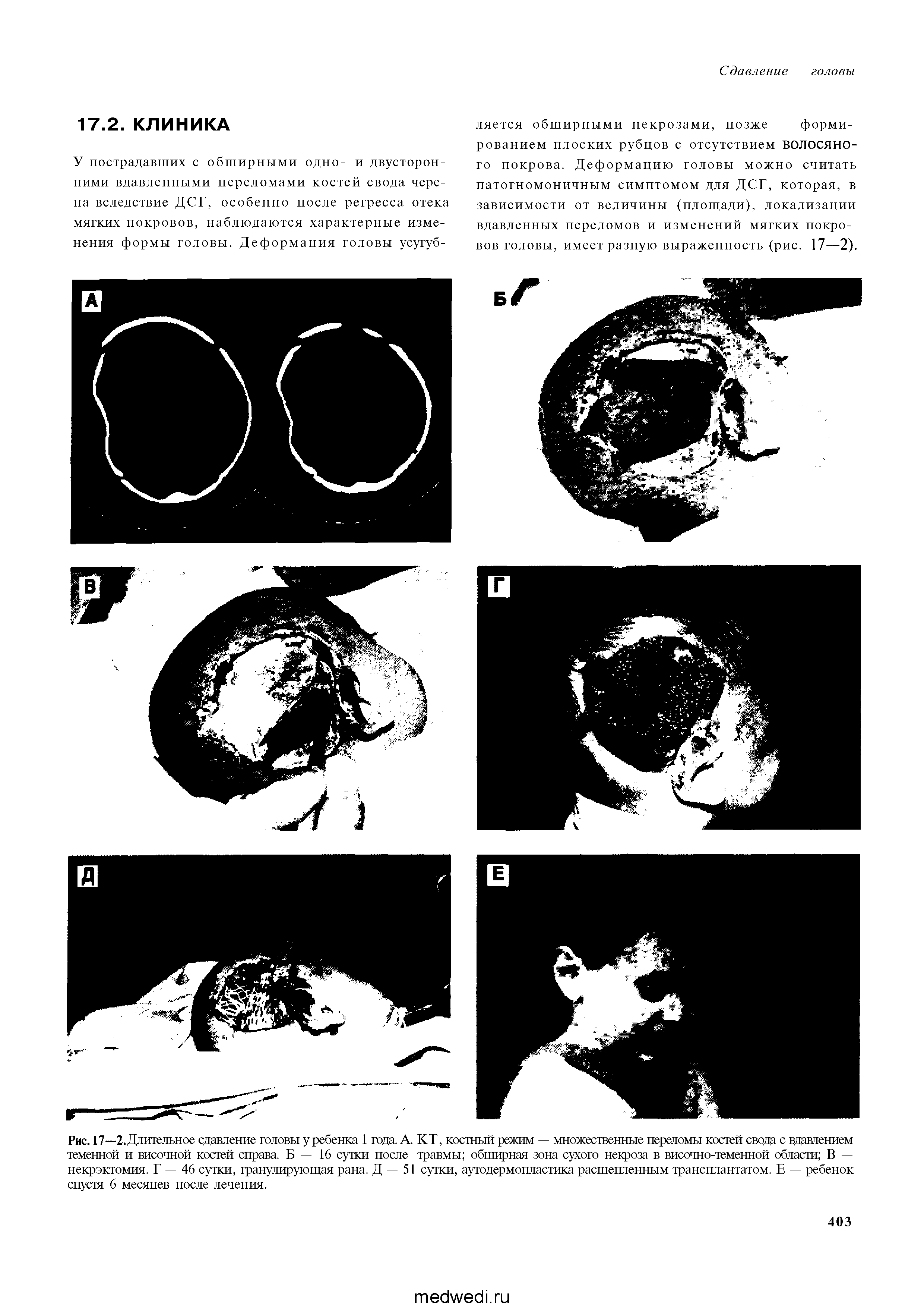 Рис. 17—2.Длительное сдавление головы у ребенка 1 года. А. КТ, костный режим — множественные переломы костей свода с вдавлением теменной и височной костей справа. Б — 16 сутки после травмы обширная зона сухого некроза в височно-теменной области В — некрэктомия. Г — 46 сутки, гранулирующая рана. Д — 51 сутки, аутодермопластика расщепленным трансплантатом. Е — ребенок спустя 6 месяцев после лечения.