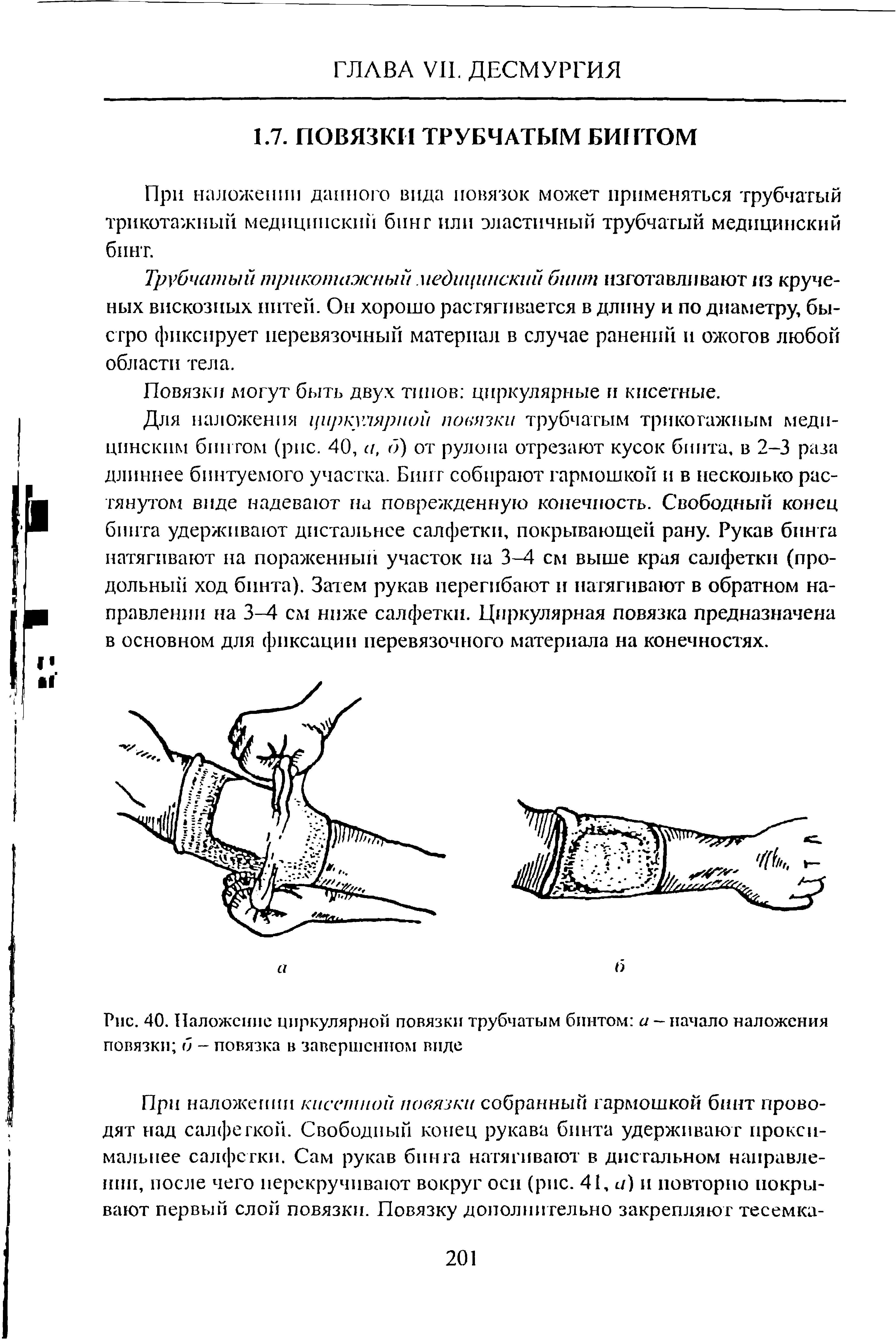 Рис. 40. Наложение циркулярной повязки трубчатым бинтом а — начало наложения повязки б - повязка в завершенном виде...