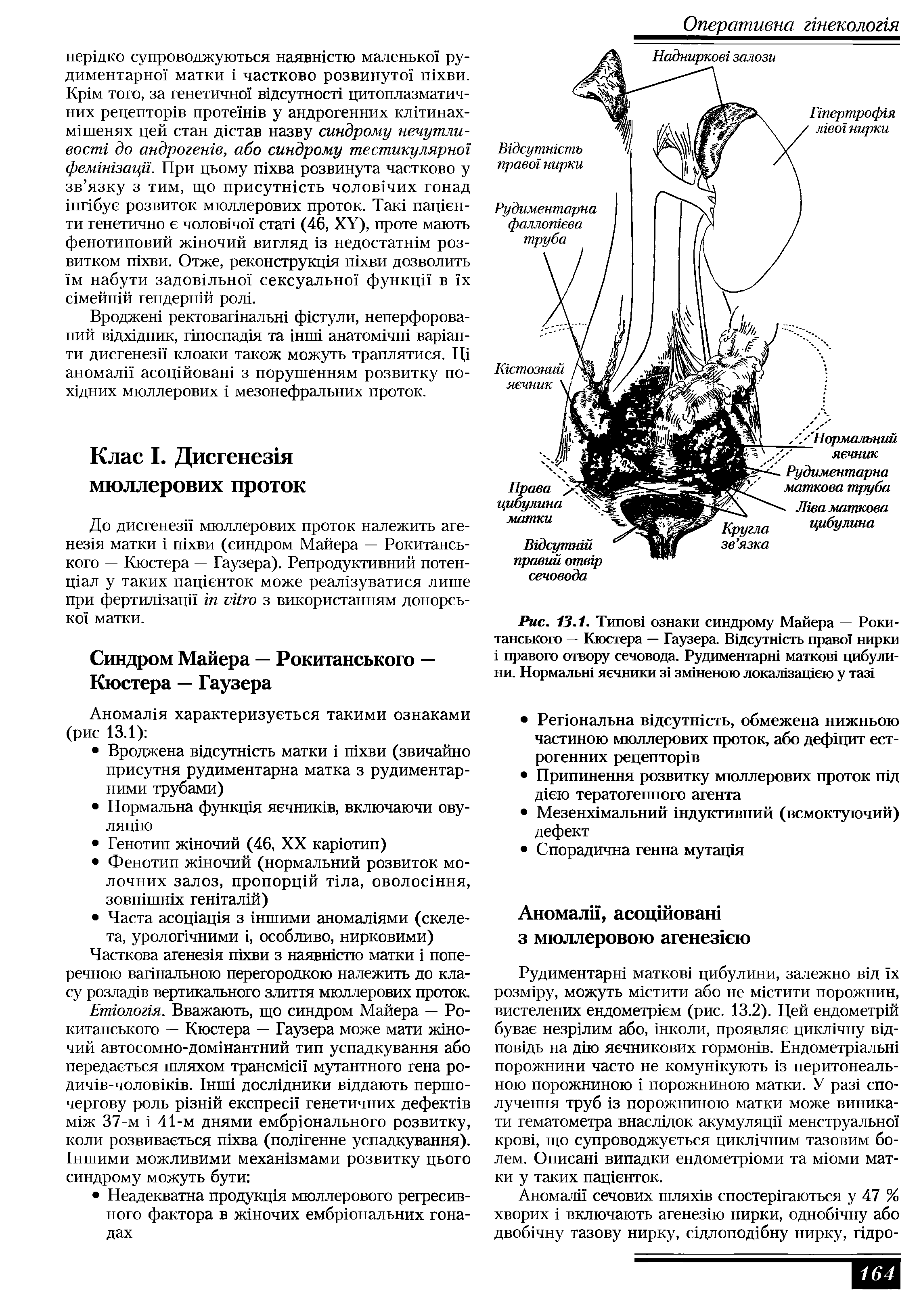 Рис. 13.1. Типов ознаки синдрому Майера — Рокитанського — Кюстера — Гаузера. В дсутн сть право нирки правого отвору сечовода. Рудиментарш матков цибули-ни. Нормалью яечники з1 змгненою локал зац1ею у таз ...
