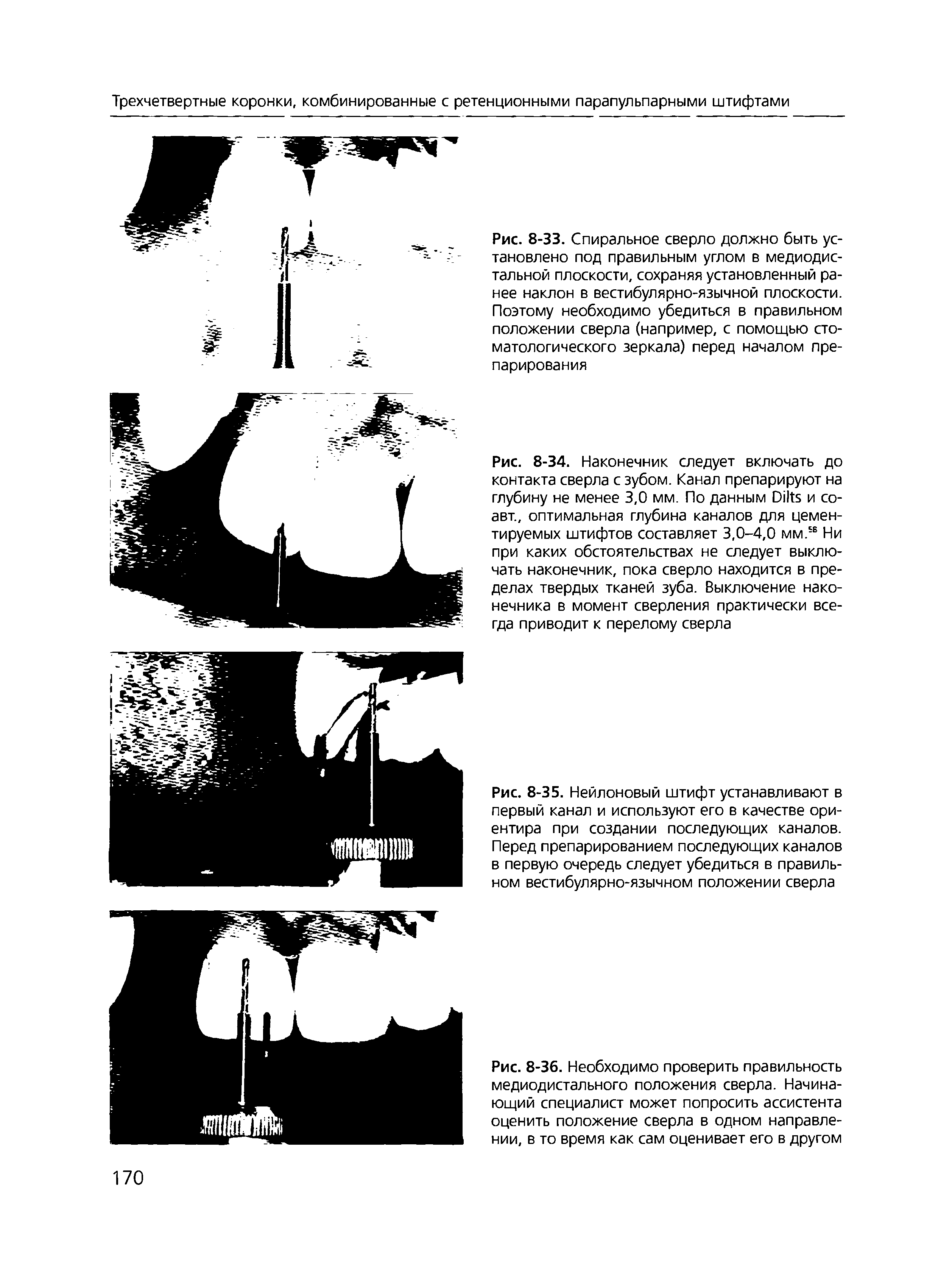 Рис. 8-33. Спиральное сверло должно быть установлено под правильным углом в медиодис-тальной плоскости, сохраняя установленный ранее наклон в вестибулярно-язычной плоскости. Поэтому необходимо убедиться в правильном положении сверла (например, с помощью стоматологического зеркала) перед началом препарирования...