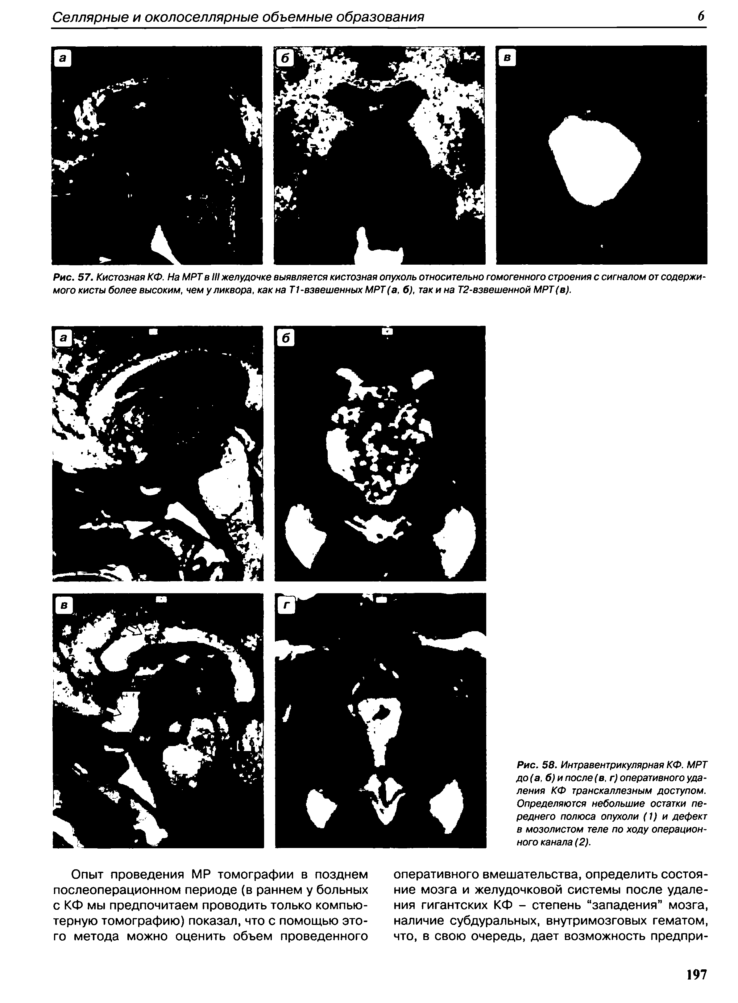 Рис. 58. Интравентрикулярная КФ. МРТ до(а, б) и после (в, г) оперативного удаления КФ транскаллезным доступом. Определяются небольшие остатки переднего полюса опухоли (1) и дефект в мозолистом теле по ходу операционного канала (2).