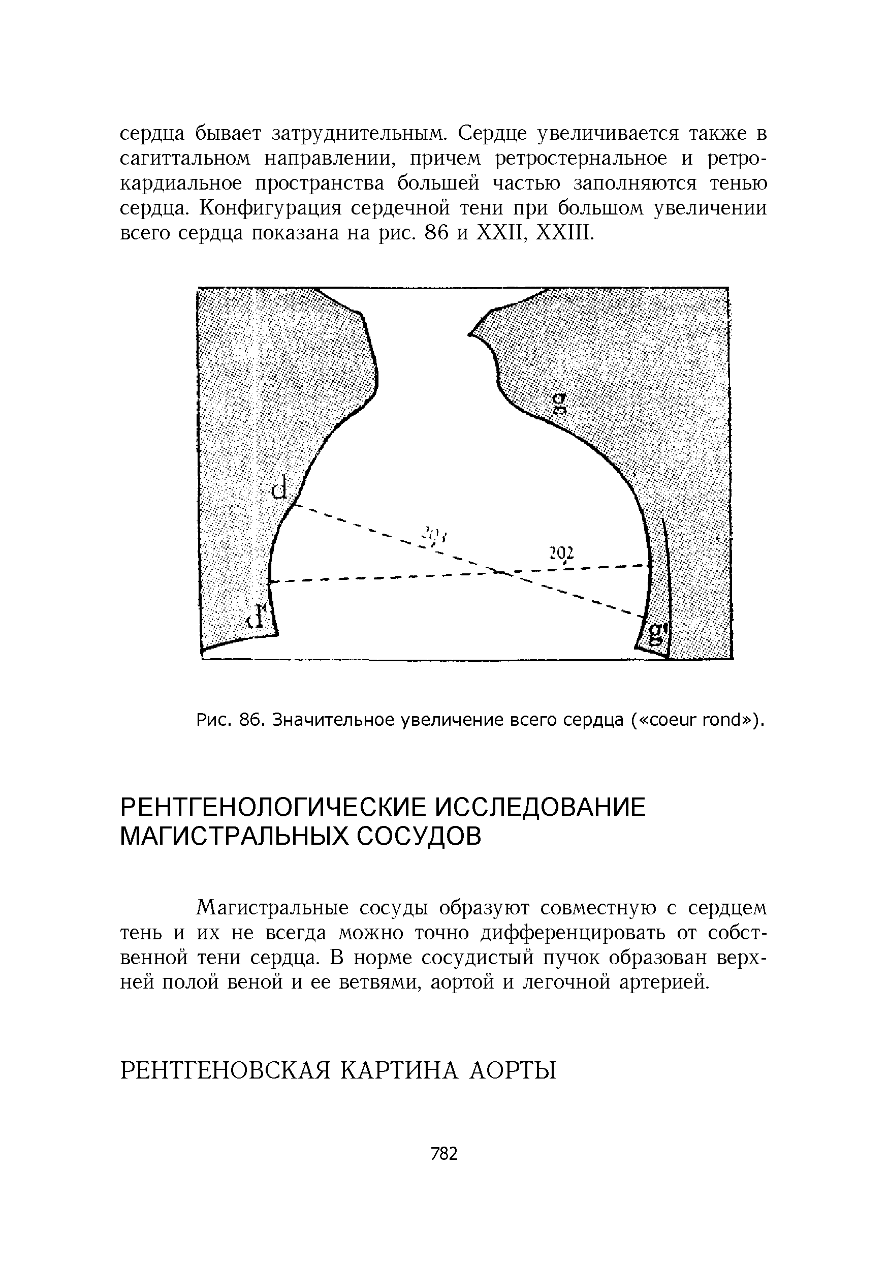 Рис. 86. Значительное увеличение всего сердца ( ).