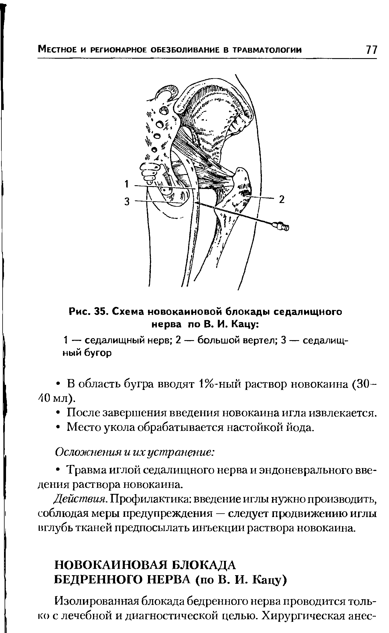 Рис. 35. Схема новокаиновой блокады седалищного нерва по В. И. Кацу ...