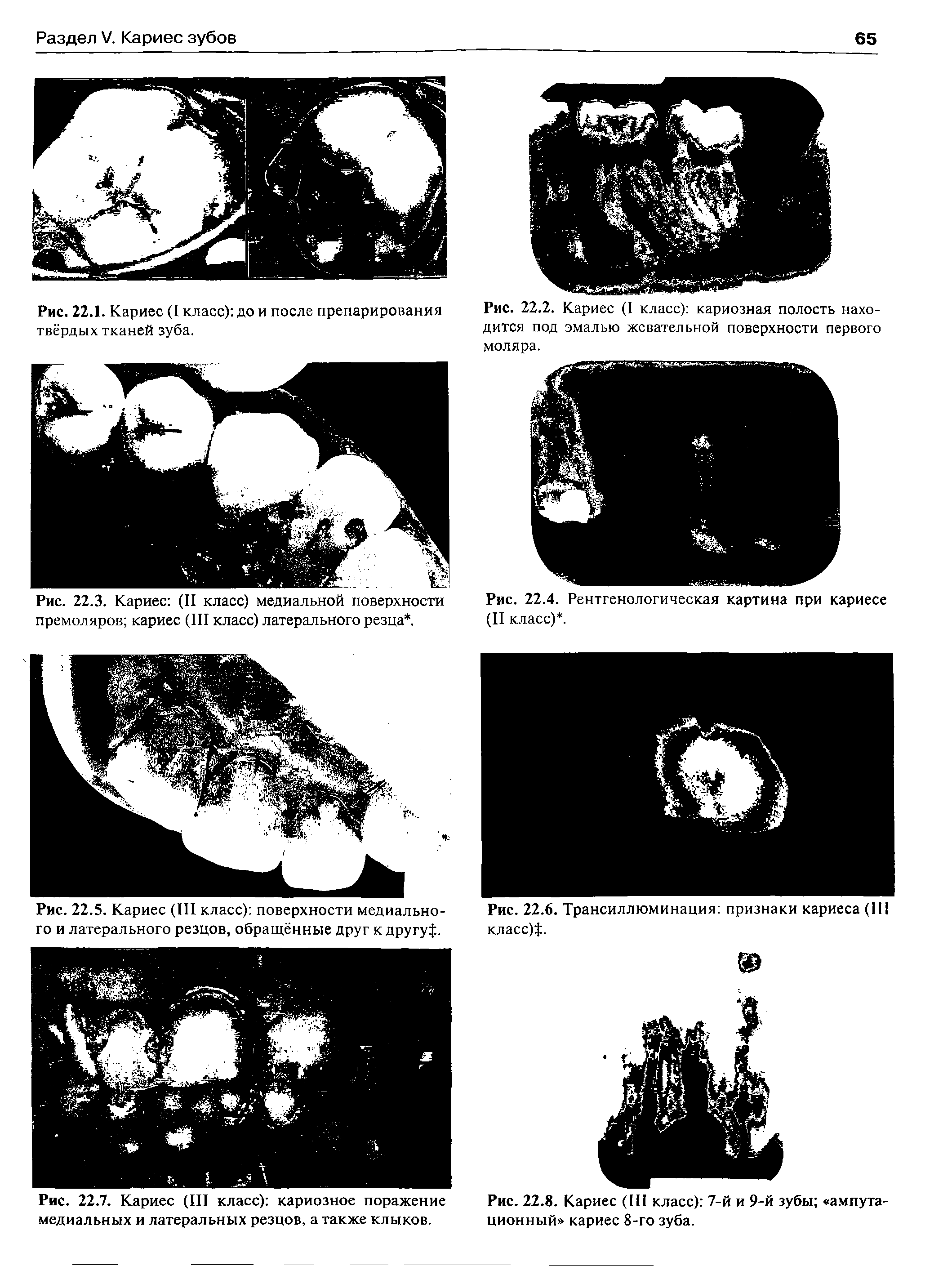 Рис. 22.2. Кариес (I класс) кариозная полость находится под эмалью жевательной поверхности первого моляра.