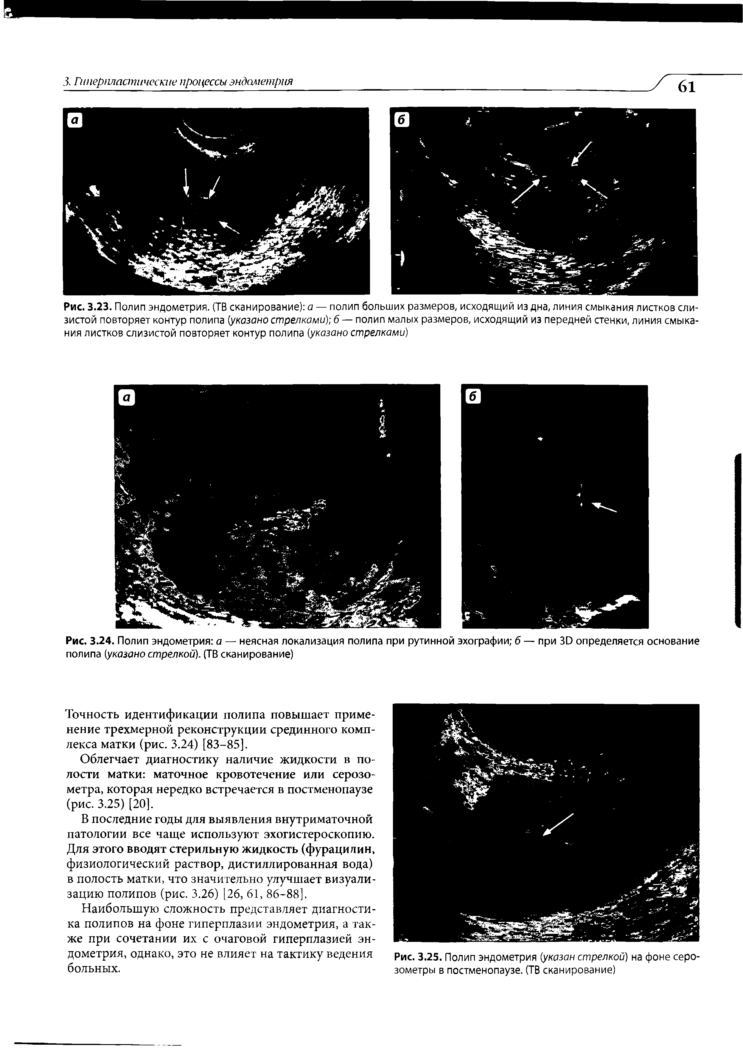 Рис. 3.24. Полип эндометрия а — неясная локализация полипа при рутинной эхографии б — при 30 определяется основание полипа (указано стрелкой). (ТВ сканирование)...