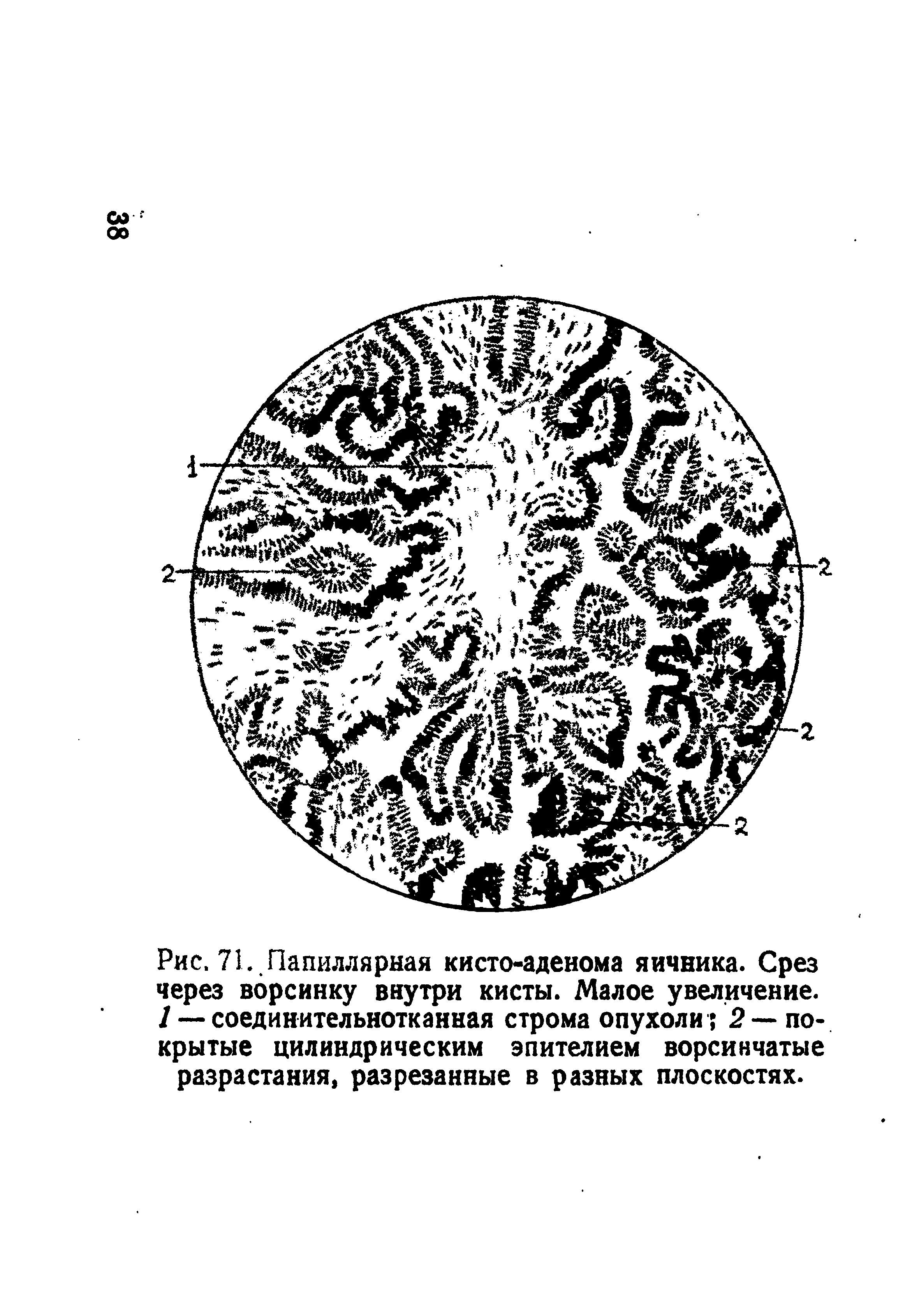 Рис. 71. Папиллярная кисто-аденома яичника. Срез через ворсинку внутри кисты. Малое увеличение, /-—соединительнотканная строма опухоли 2 — покрытые цилиндрическим эпителием ворсинчатые разрастания, разрезанные в разных плоскостях.