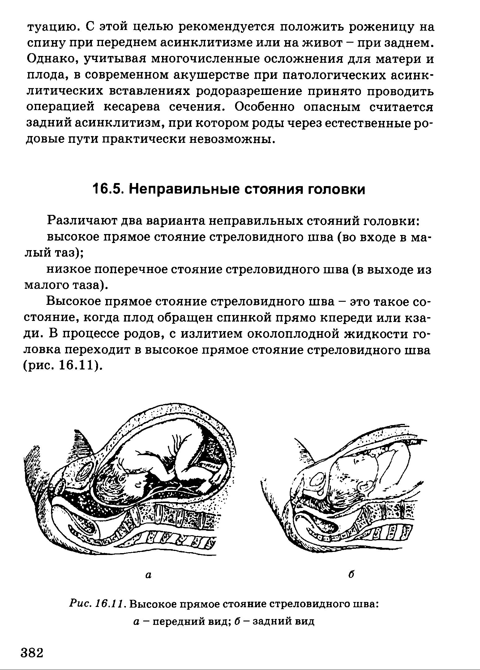 Рис. 16.11. Высокое прямое стояние стреловидного шва а - передний вид б - задний вид...