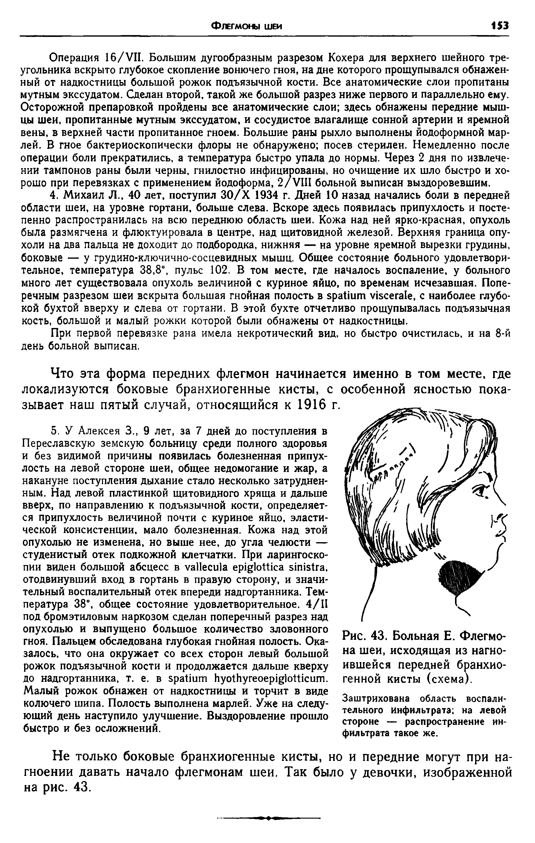 Рис. 43. Больная Е. Флегмона шеи, исходящая из нагноившейся передней бранхиогенной кисты (схема).