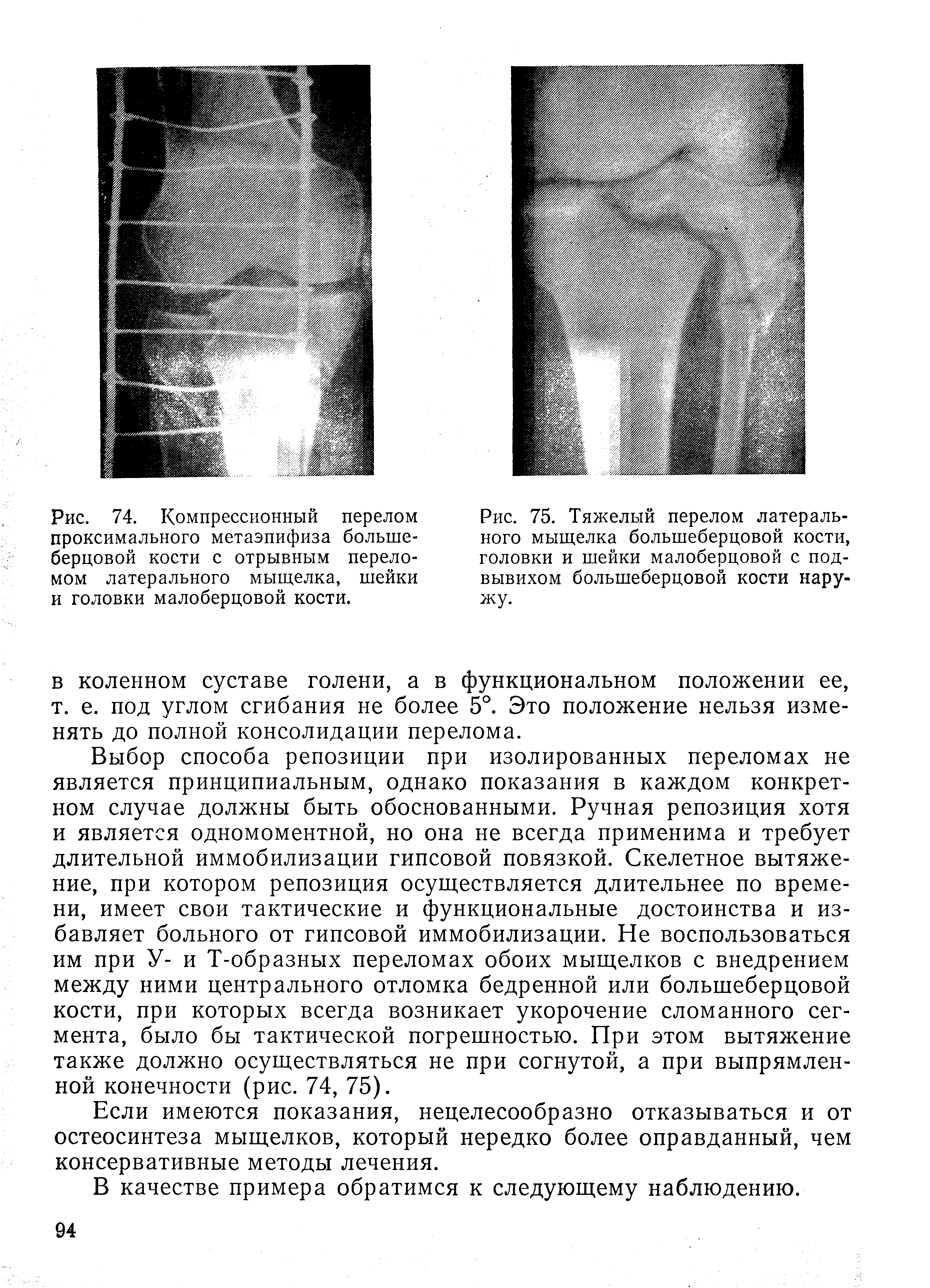 Рис. 75. Тяжелый перелом латерального мыщелка большеберцовой кости, головки и шейки малоберцовой с подвывихом большеберцовой кости наружу.