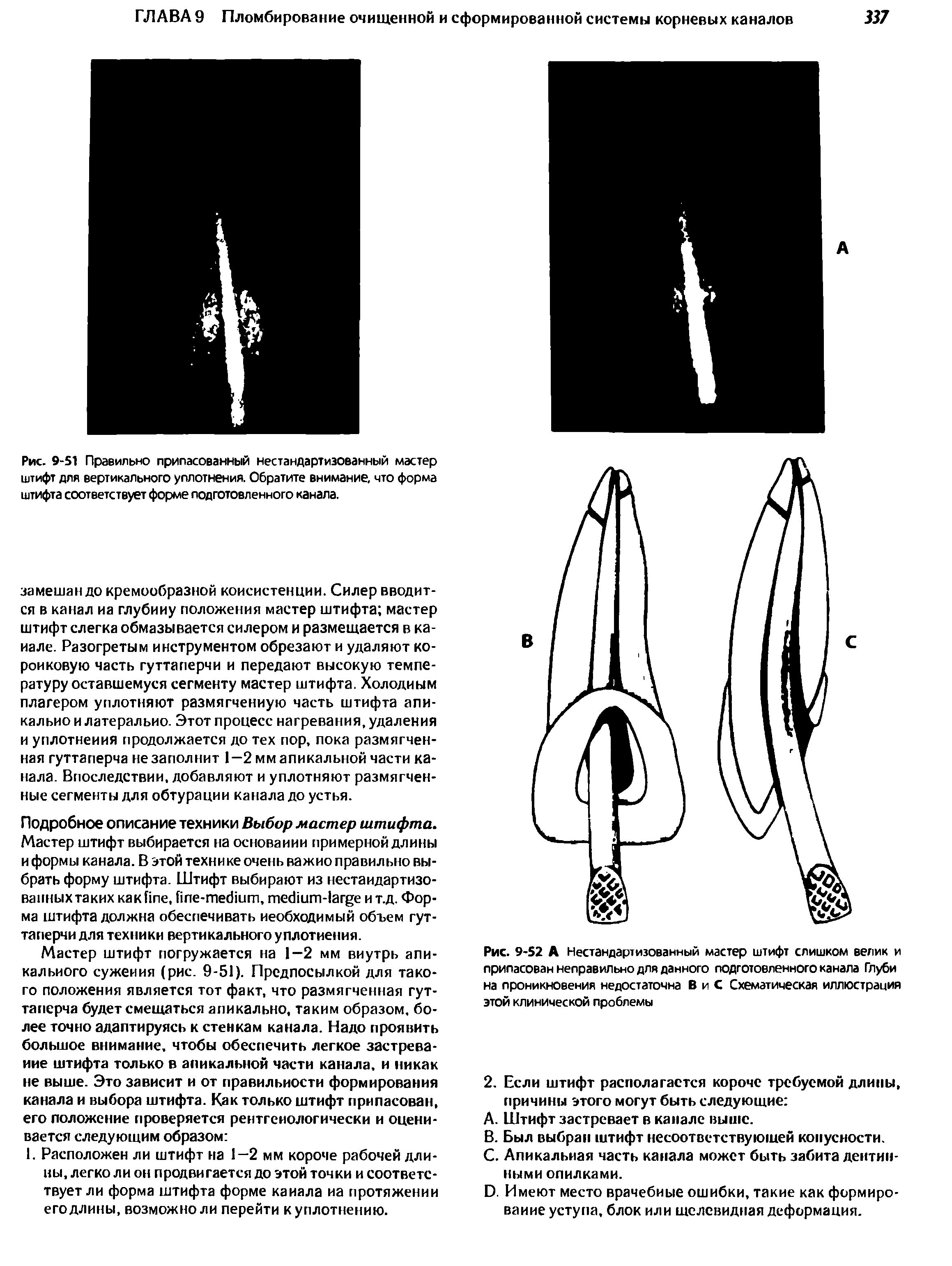 Рис. 9-52 А Нестандартизованный мастер штифт слишком велик и припасован неправильно для данного подготовленного канала Глуби на проникновения недостаточна В и С Схематическая иллюстрация этой клинической проблемы...