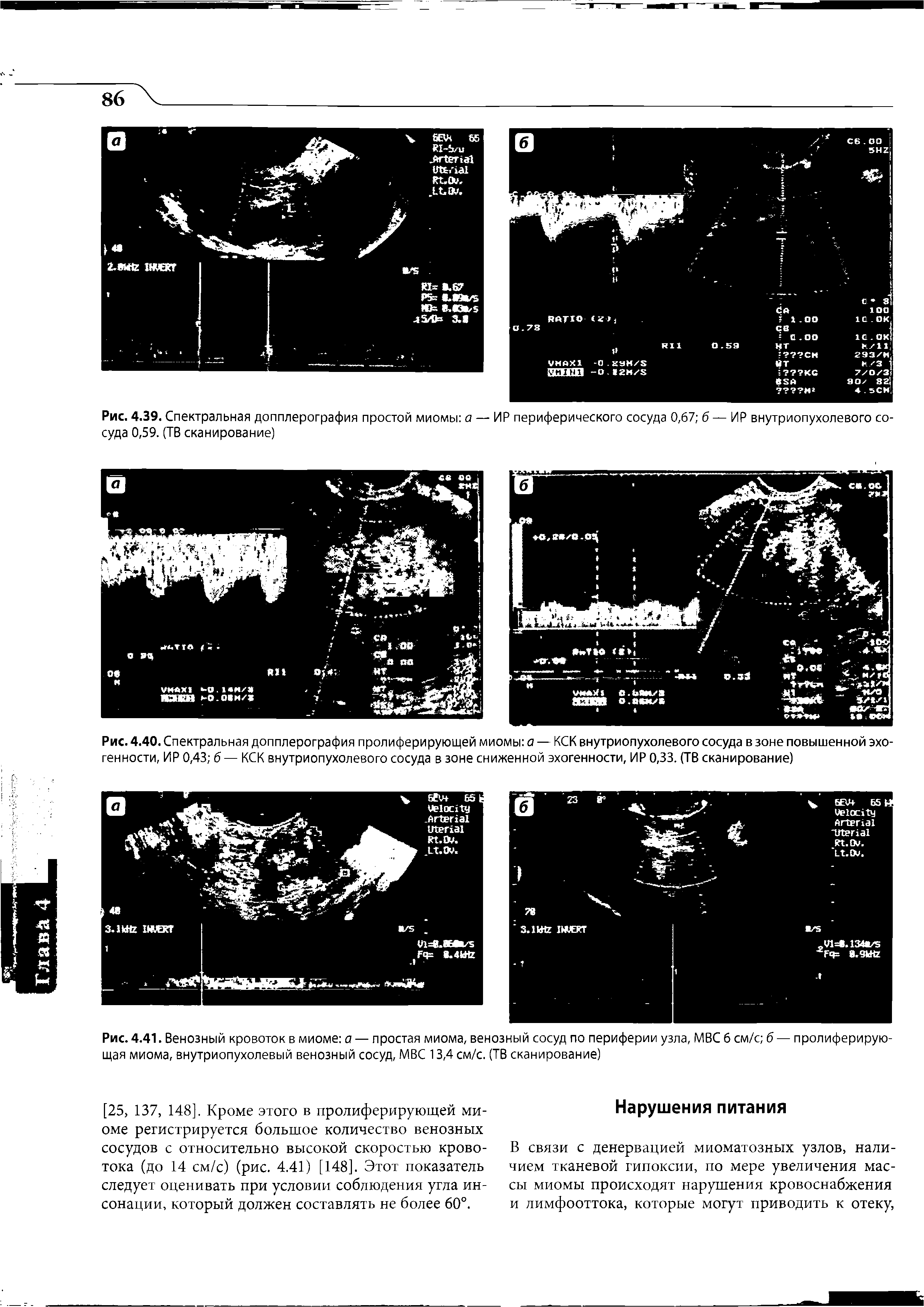 Рис. 4.41. Венозный кровоток в миоме а — простая миома, венозный сосуд по периферии узла, МВС б см/с б — пролиферирующая миома, внутриопухолевый венозный сосуд, МВС 13,4 см/с. (ТВ сканирование)...
