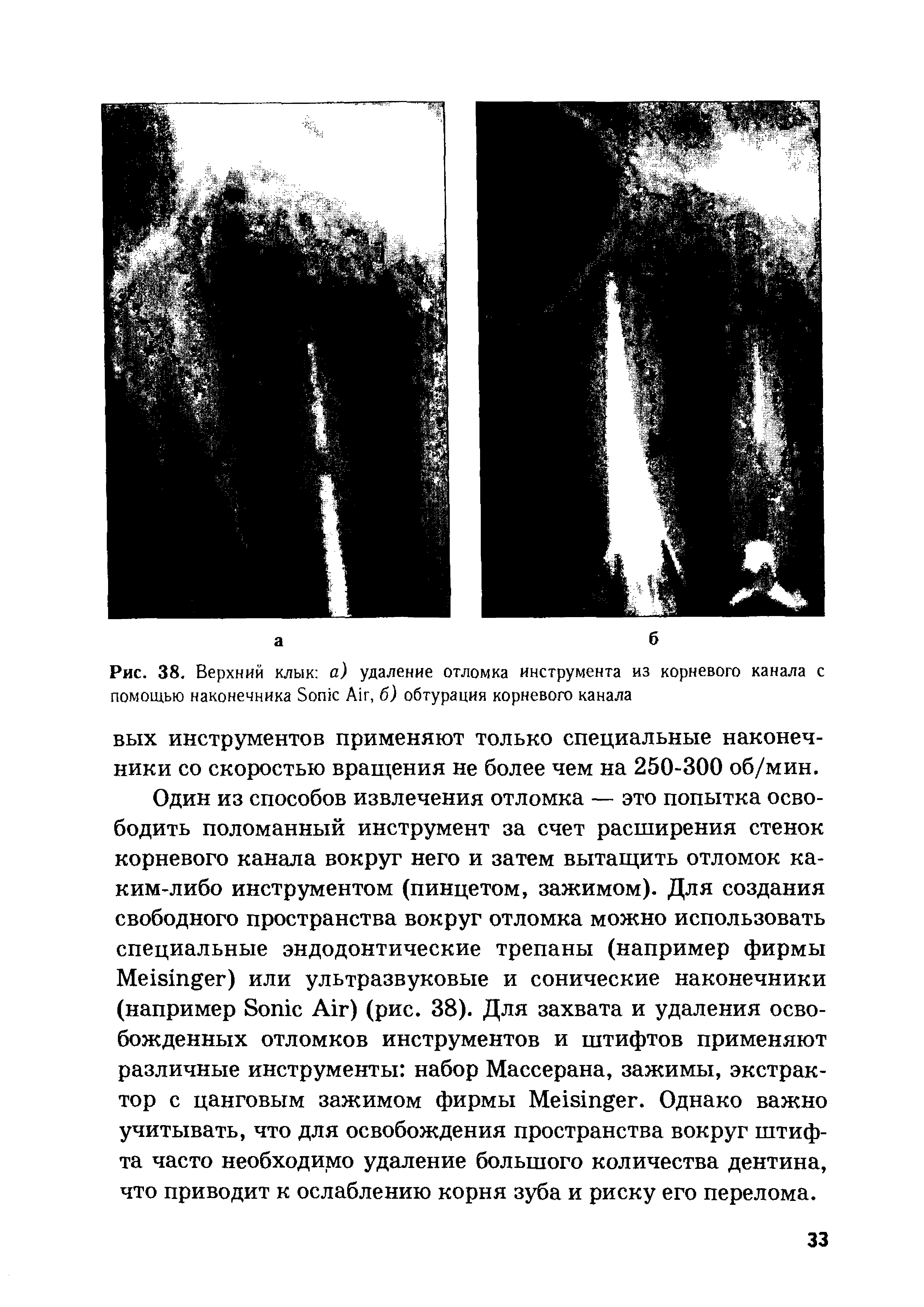 Рис. 38. Верхний клык а) удаление отломка инструмента из корневого канала с помощью наконечника Зопк Аи, б) обтурация корневого канала...