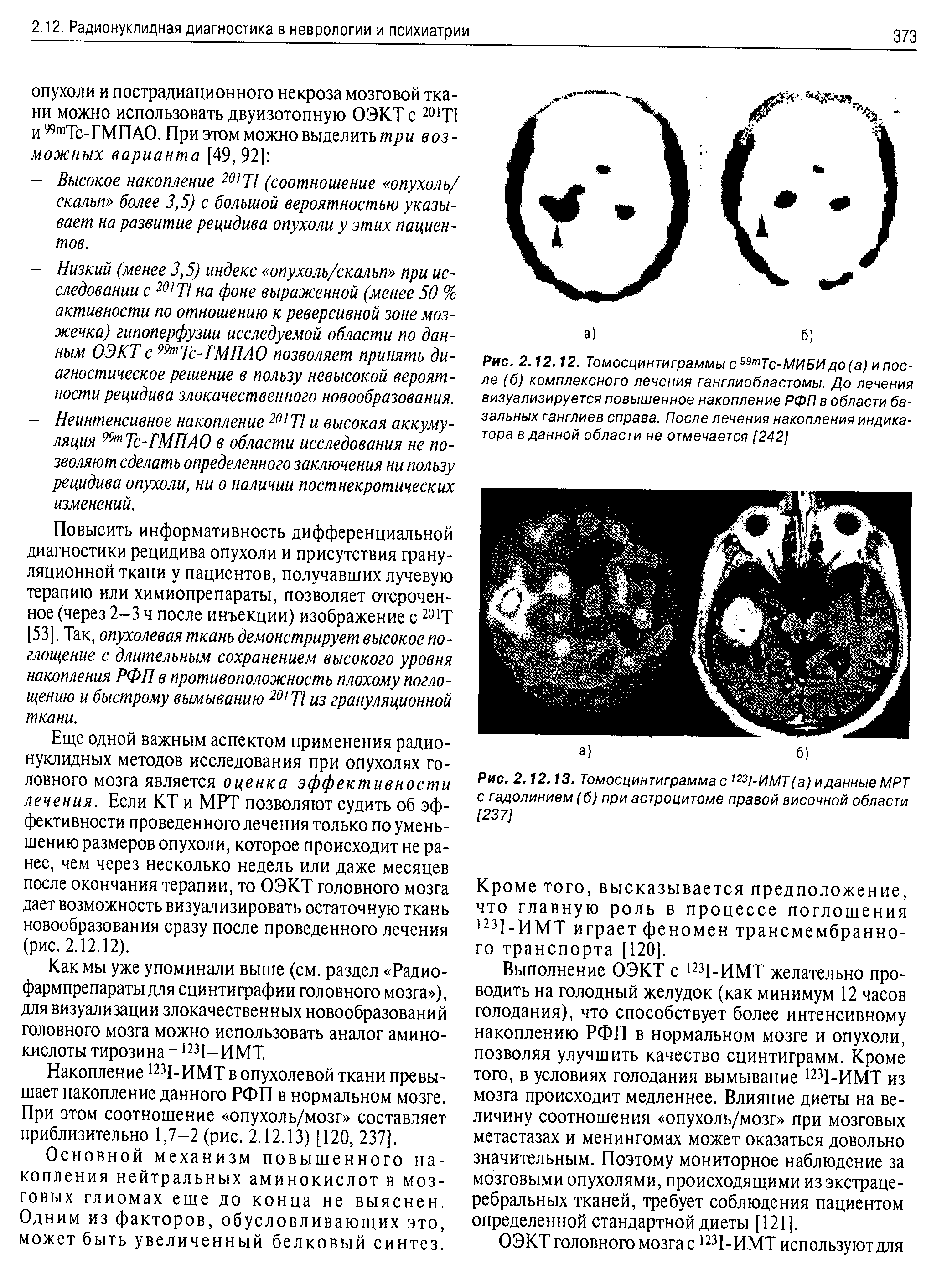 Рис. 2.12.13. Томосцинтиграмма с, 231-ИМТ (а) и данные МРТ с гадолинием (б) при астроцитоме правой височной области [237]...