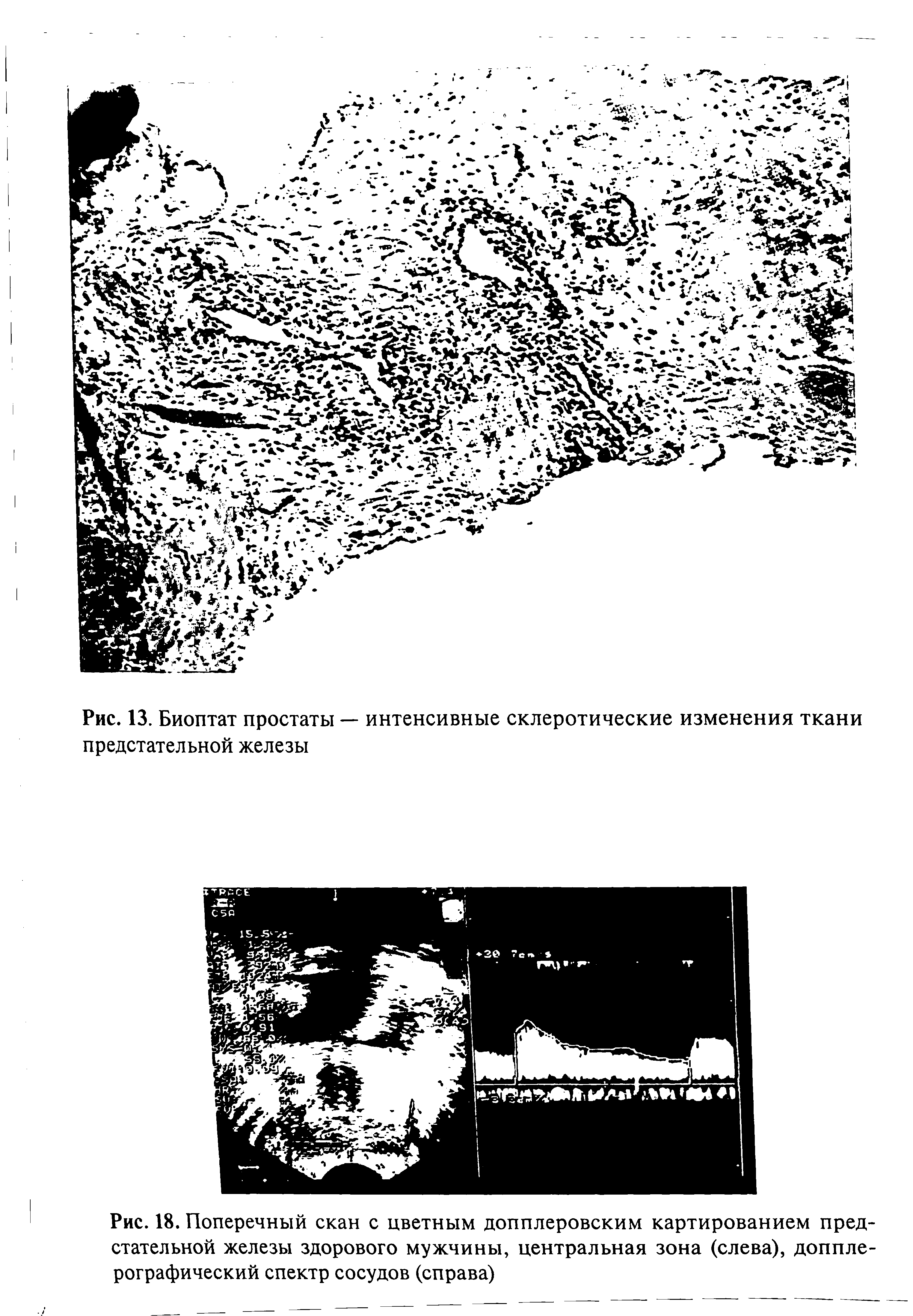 Рис. 18. Поперечный скан с цветным допплеровским картированием предстательной железы здорового мужчины, центральная зона (слева), допплерографический спектр сосудов (справа)...