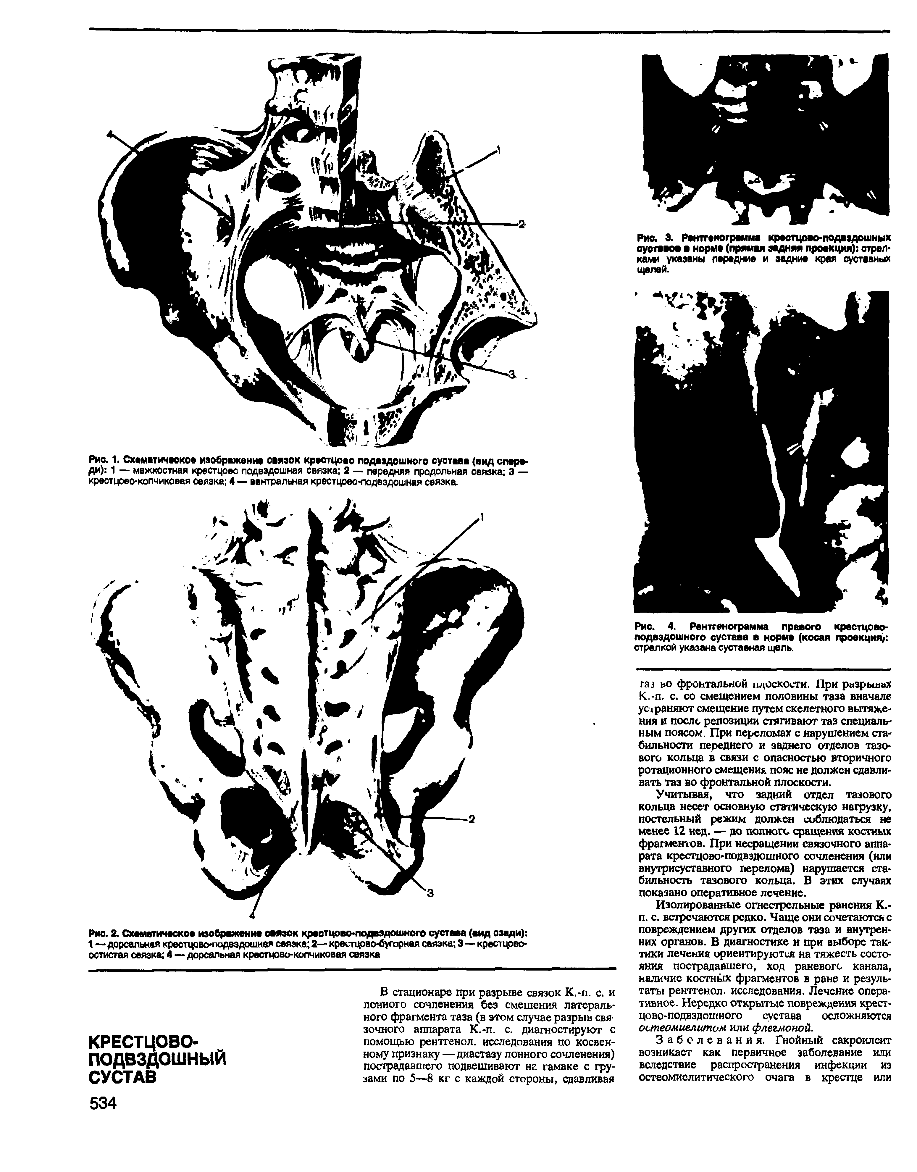 Рис. 4. Рентгенограмма правого крестцово-подвздошного сустава в норме (косая проекция/ стрелкой указана суставная щель.