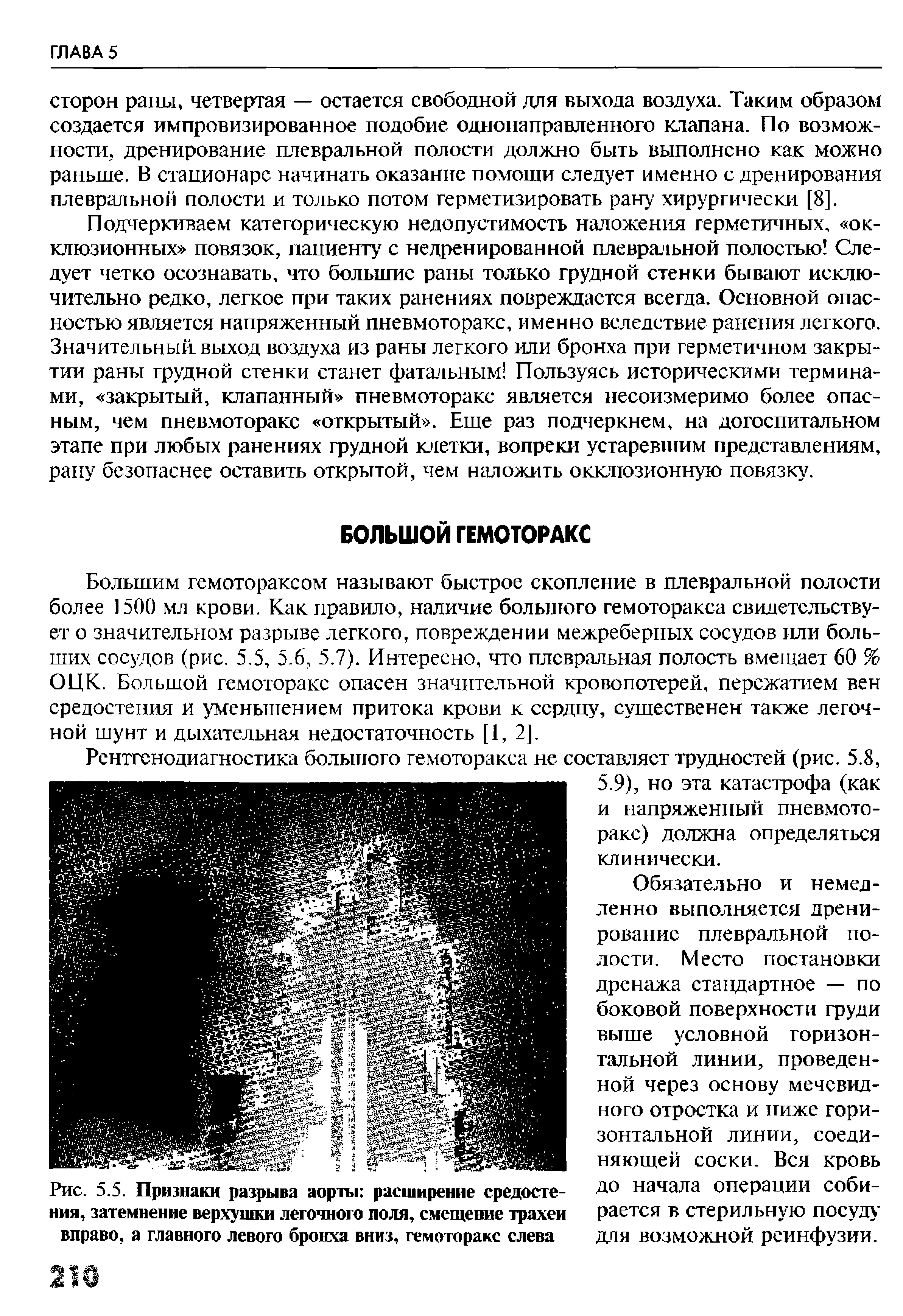 Рис. 5.5. Признаки разрыва аорты расширение средостения, затемнение верхушки легочного поля, смещение трахеи вправо, а главного левого бронха вниз, гемоторакс слева...