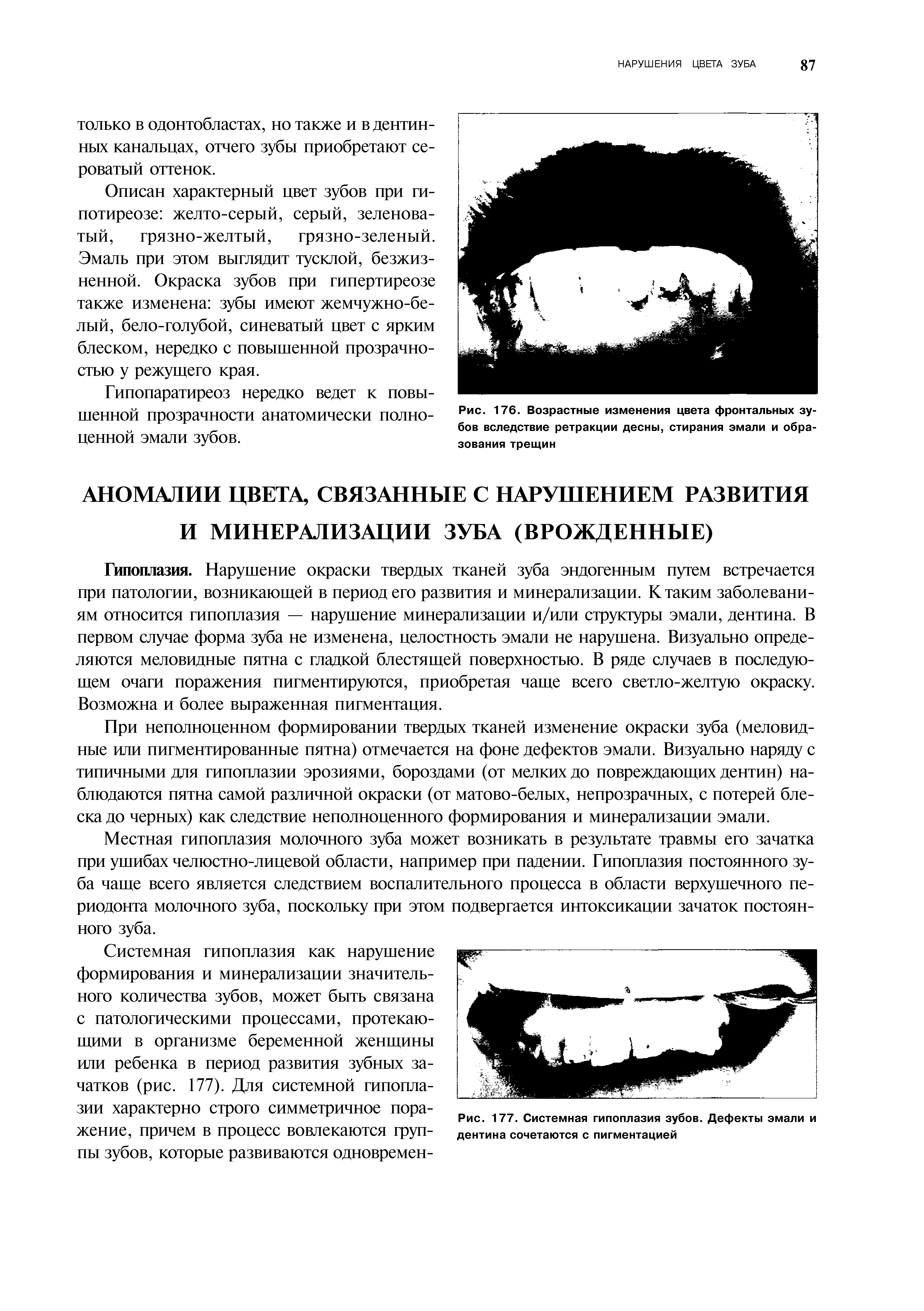 Рис. 177. Системная гипоплазия зубов. Дефекты эмали и дентина сочетаются с пигментацией...