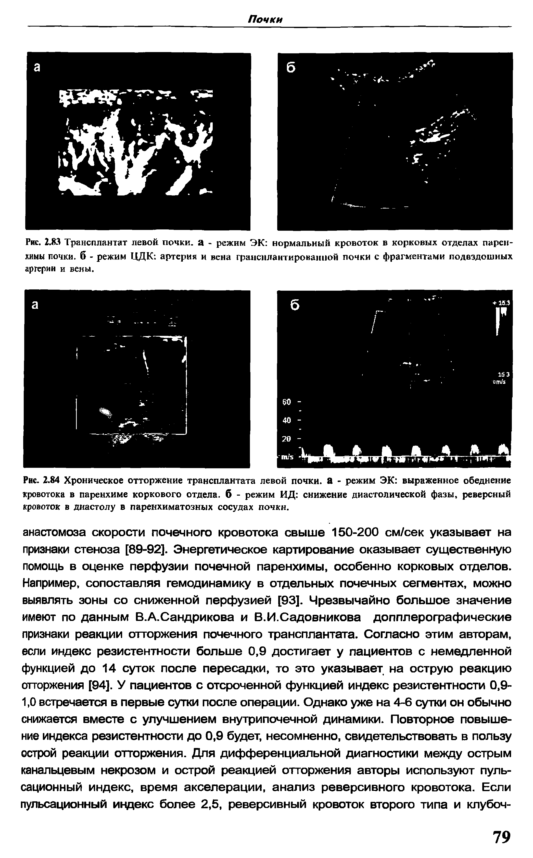 Рис. 2.84 Хроническое отторжение трансплантата левой почки, а - режим ЭК выраженное обеднение кровотока в паренхиме коркового отдела, б - режим ИД снижение диастолической фазы, реверсный кровоток в диастолу в паренхиматозных сосудах почки.