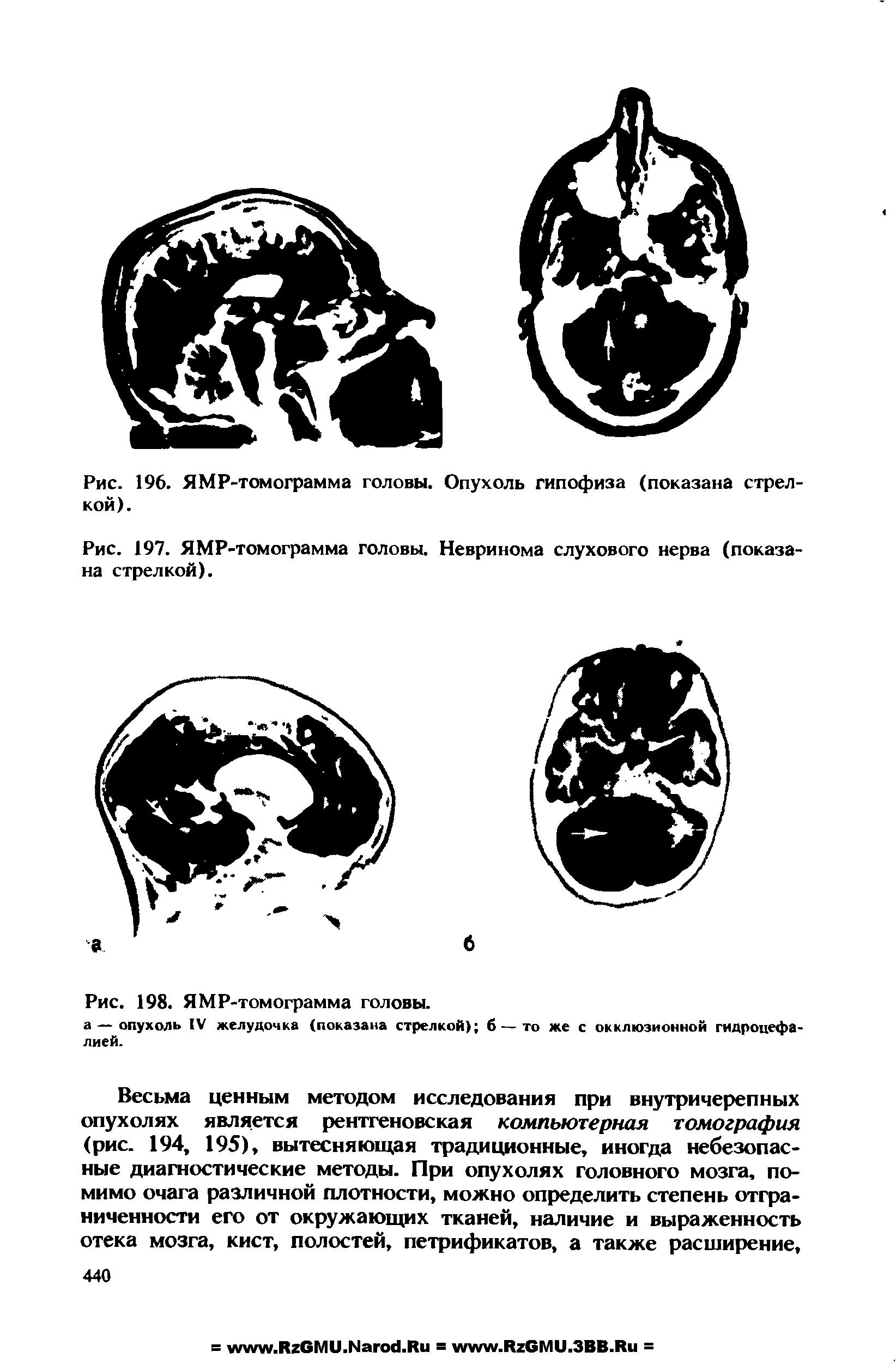 Рис. 197. ЯМР-томограмма головы. Невринома слухового нерва (показана стрелкой).