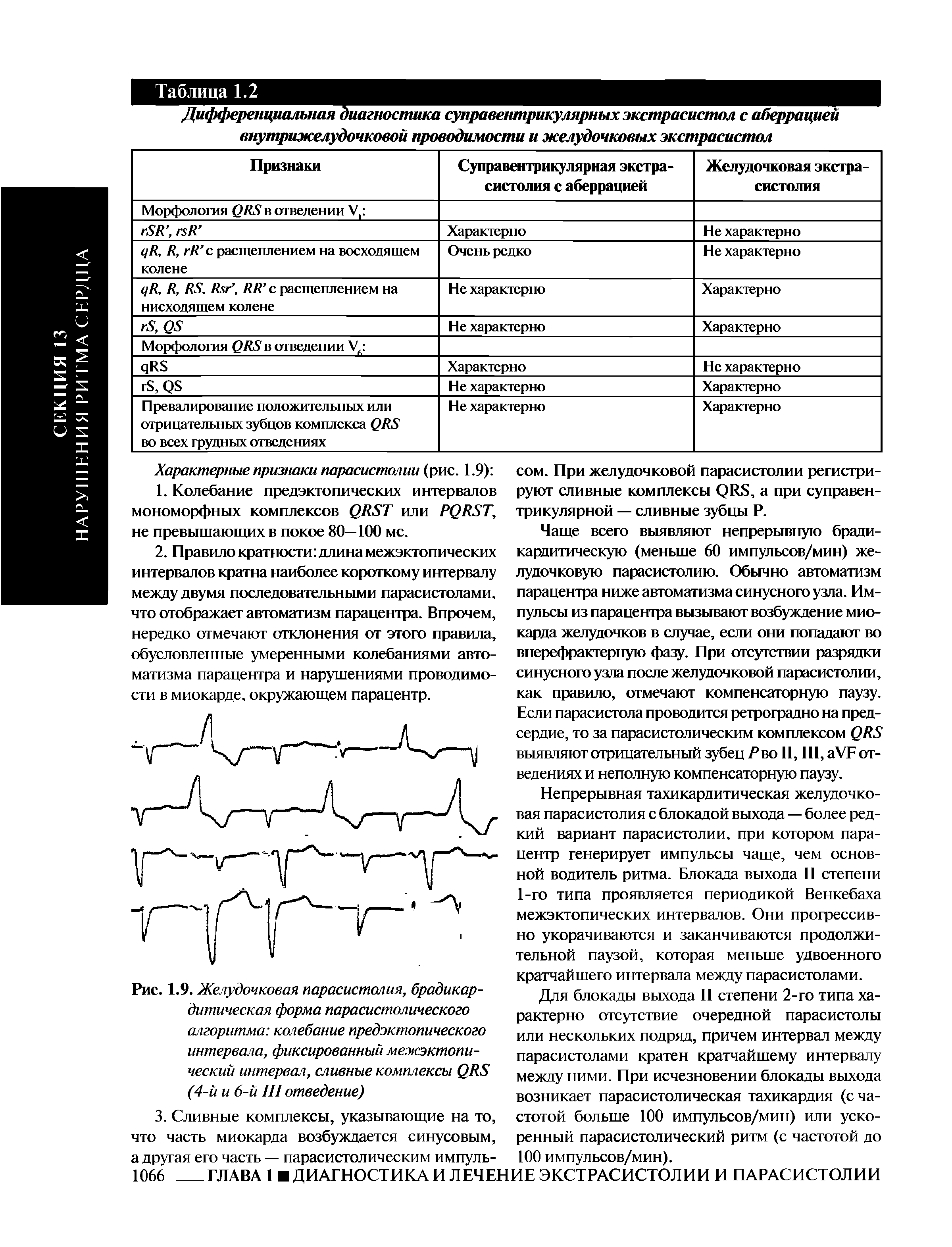 Рис. 1.9. Желудочковая парасистолия, брадикар-дитическая форма парасистолического алгоритма колебание предэктопического интервала, фиксированный межэктопический интервал, сливные комплексы QRS (4-й и 6-й III отведение)...