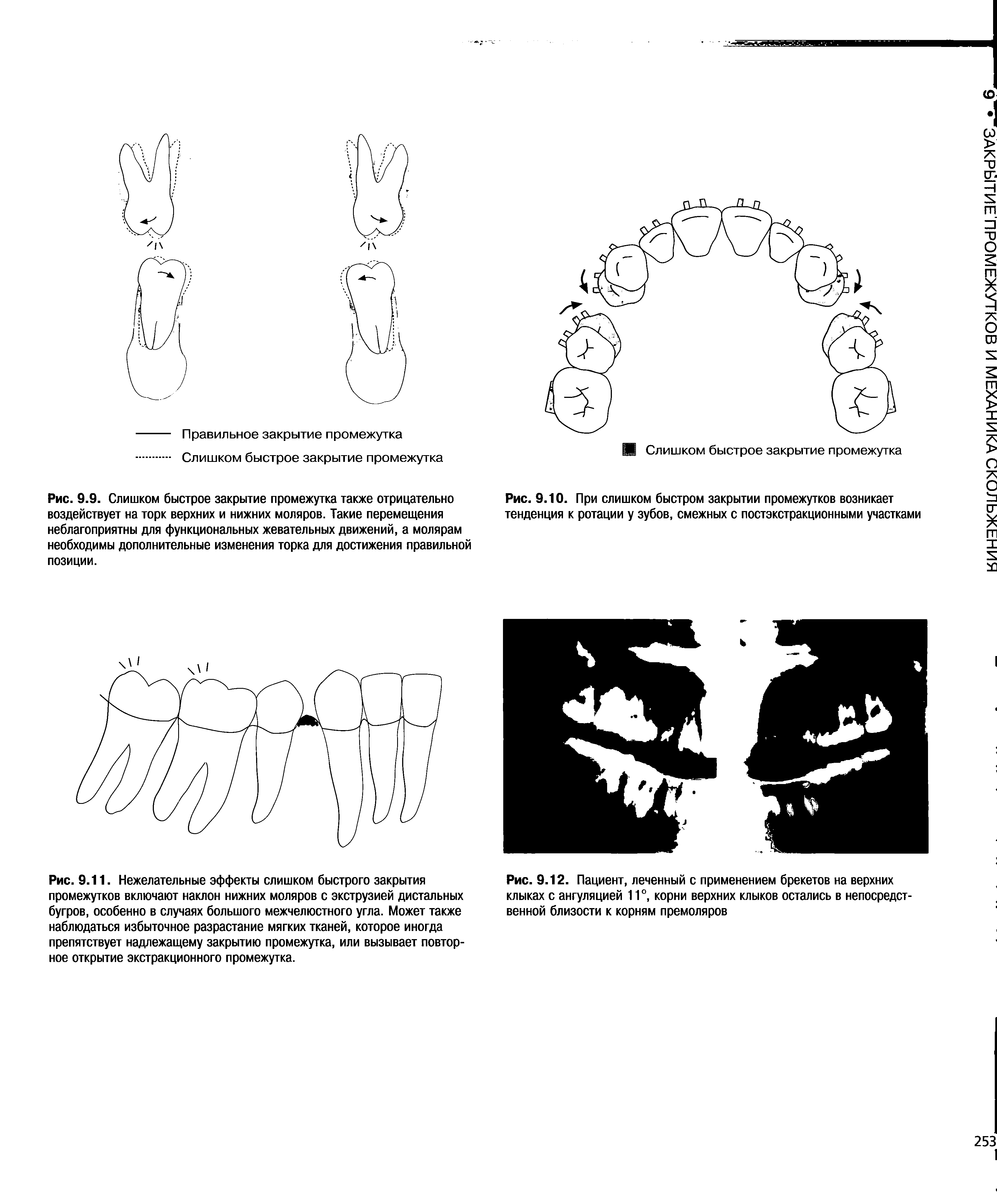 Рис. 9.9. Слишком быстрое закрытие промежутка также отрицательно воздействует на торк верхних и нижних моляров. Такие перемещения неблагоприятны для функциональных жевательных движений, а молярам необходимы дополнительные изменения торка для достижения правильной позиции.