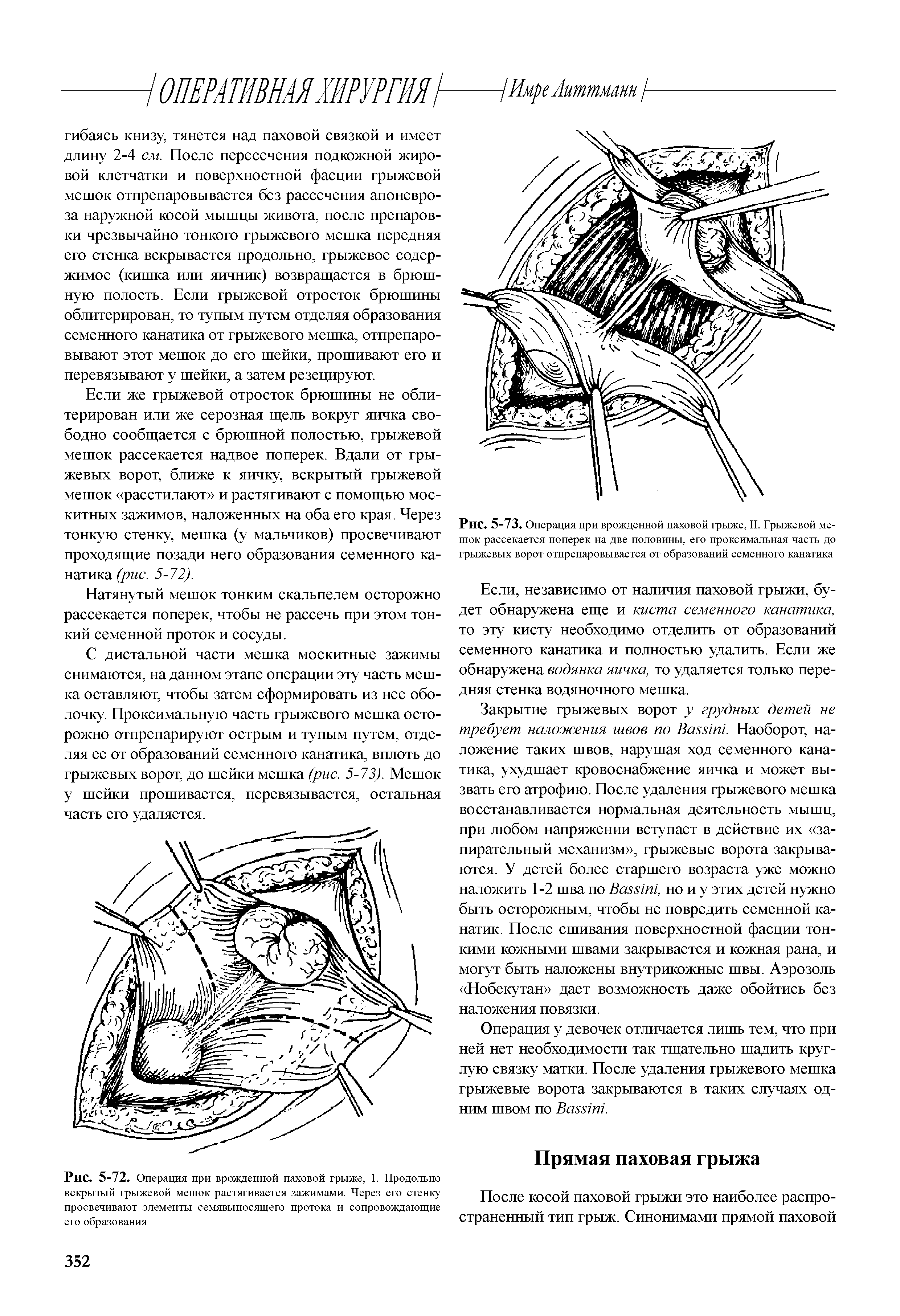 Рис. 5-72. Операция при врожденной паховой грыже, 1. Продольно вскрытый грыжевой мешок растягивается зажимами. Через его стенку просвечивают элементы семявыносящего протока и сопровождающие его образования...