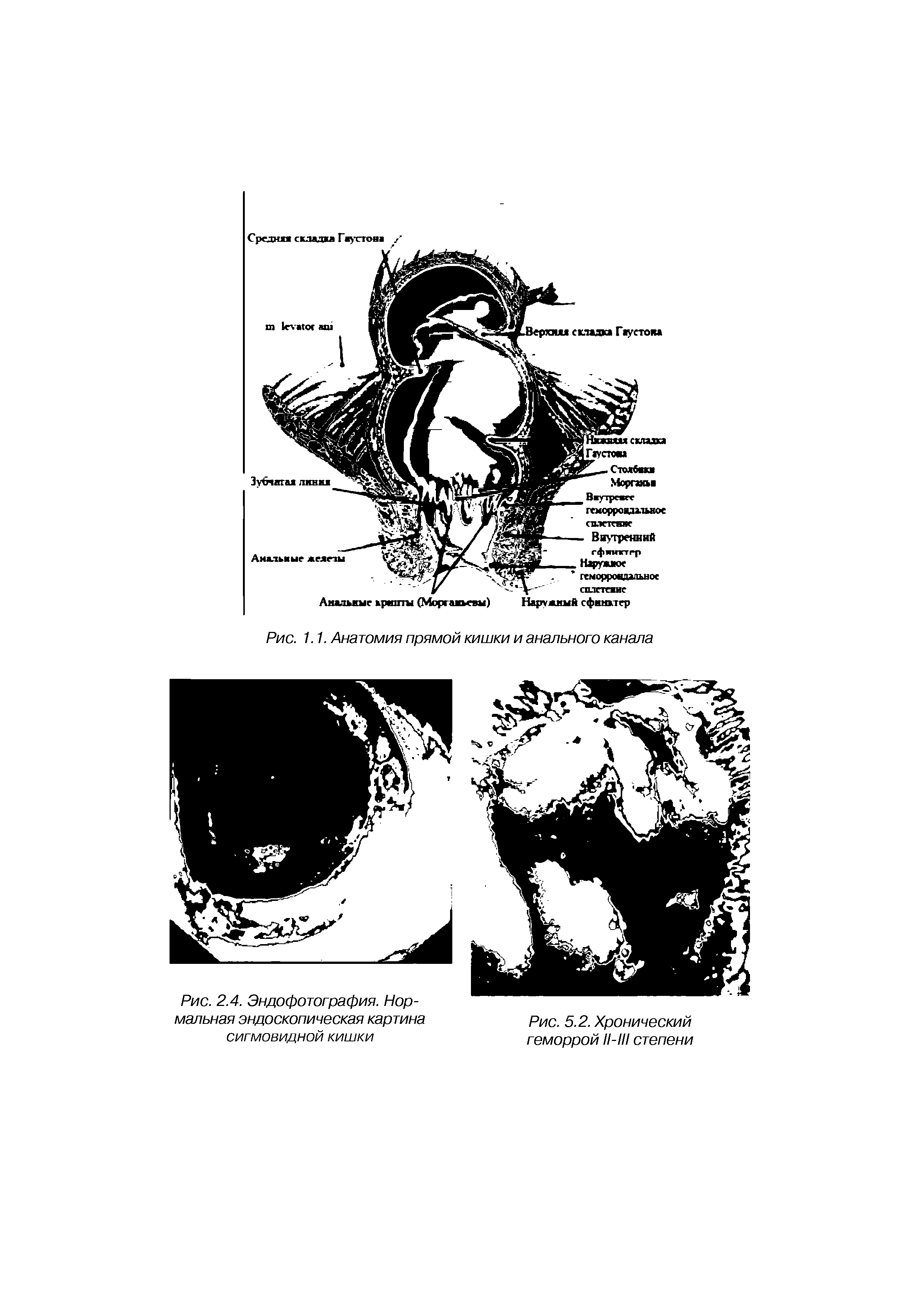 Рис. 2.4. Эндофотография. Нормальная эндоскопическая картина сигмовидной кишки...