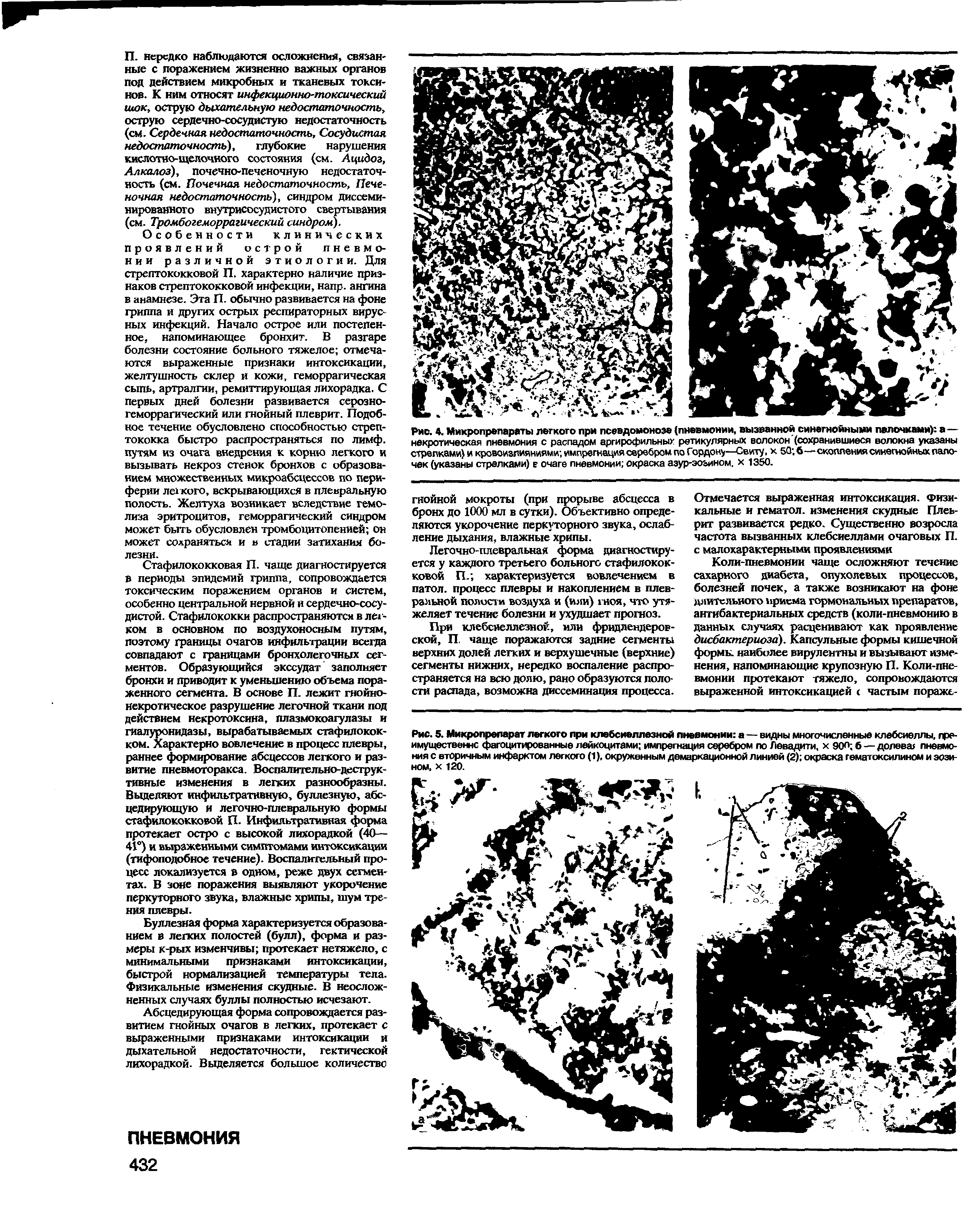 Рис. 5. Микропрепарат легкого при клебсиеллезной пневмонии а — видны многочисленные клебсиеллы, пре-имущвственнс фагоцитированные лейкоцитами импрегнация серебром по Левадити, х 90° б — долевая пневмония с вторичным инфарктом легкого (1), окруженным демаркационной линией (2) окраска гематоксилином и эозином, х 120.